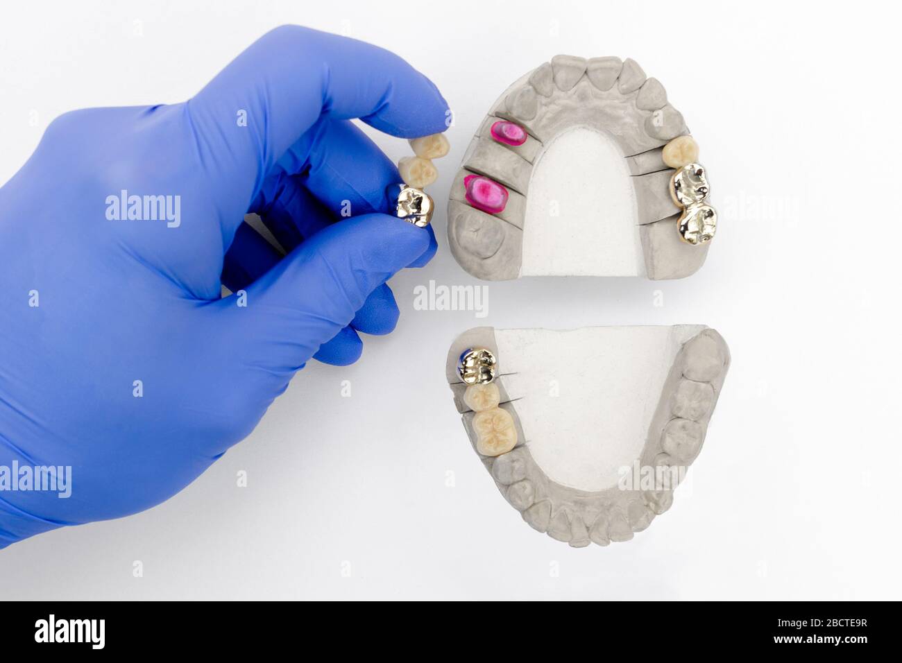 tooth restoration. dental prosthetics. the dentist's hand holds a model ...