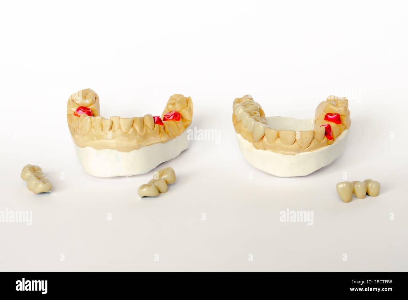 concept of orthopedic dentistry. dental prosthetics with ceramic crowns and bridges. dental bridges on the posterior teeth. aesthetic prosthetics. gyp Stock Photo