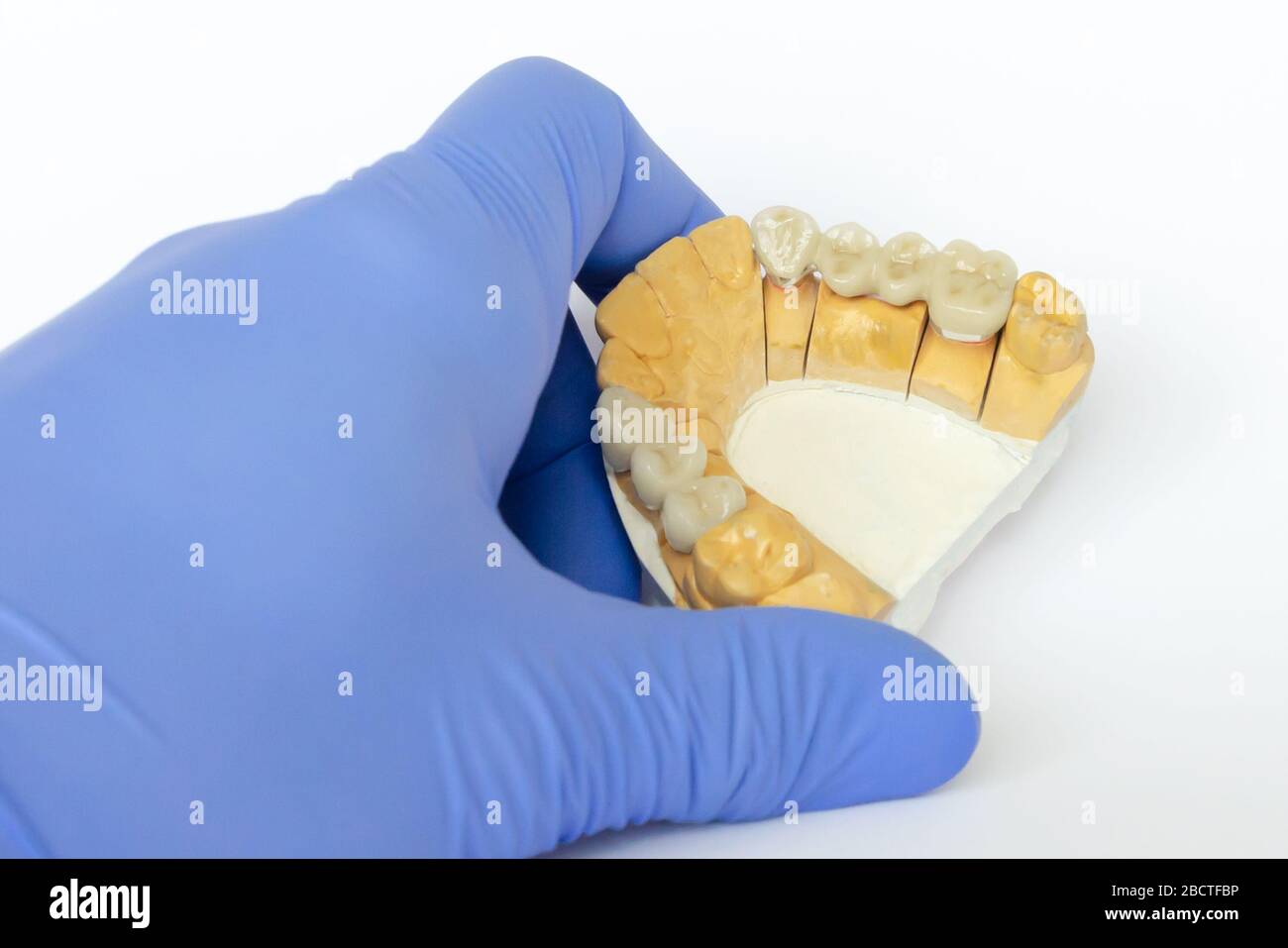 ceramic-metal bridges. non-permanent dental prosthetics. orthopedic dentistry. false teeth. ceramic teeth, ceramic bridges Stock Photo