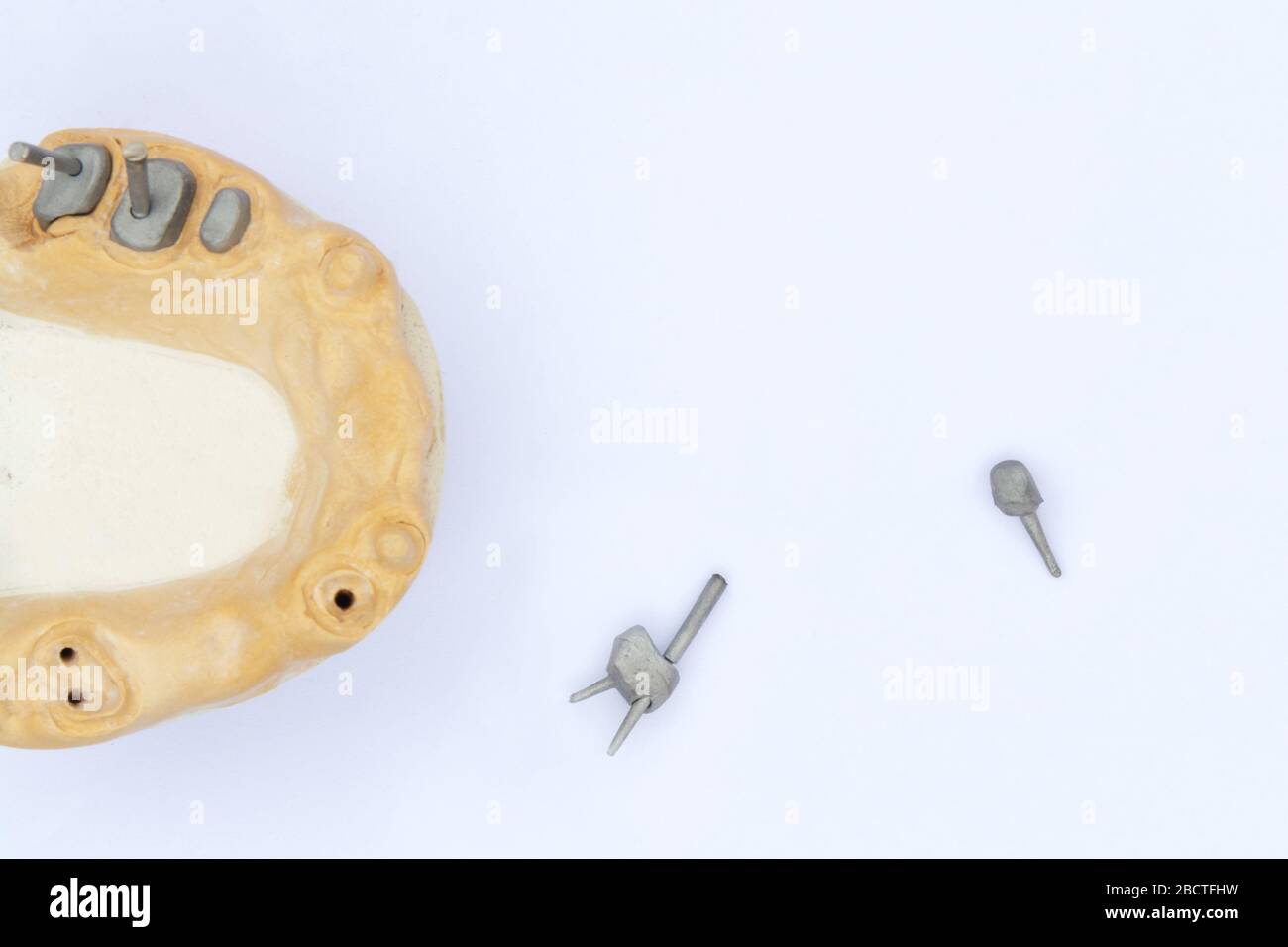 dental pins, posts and cast posts. on the left is a gypsum model of the upper jaw. concept of prosthetics on the roots of teeth. orthopedic dentistry Stock Photo