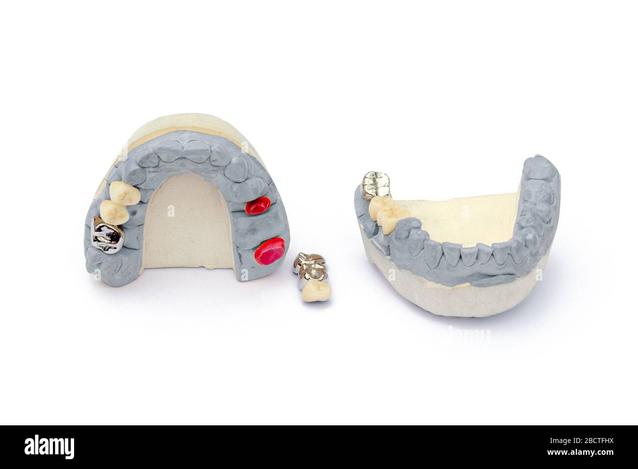 metal and ceramic artificial teeth. concept of replacing missing teeth. dental prosthetics. isolated Stock Photo