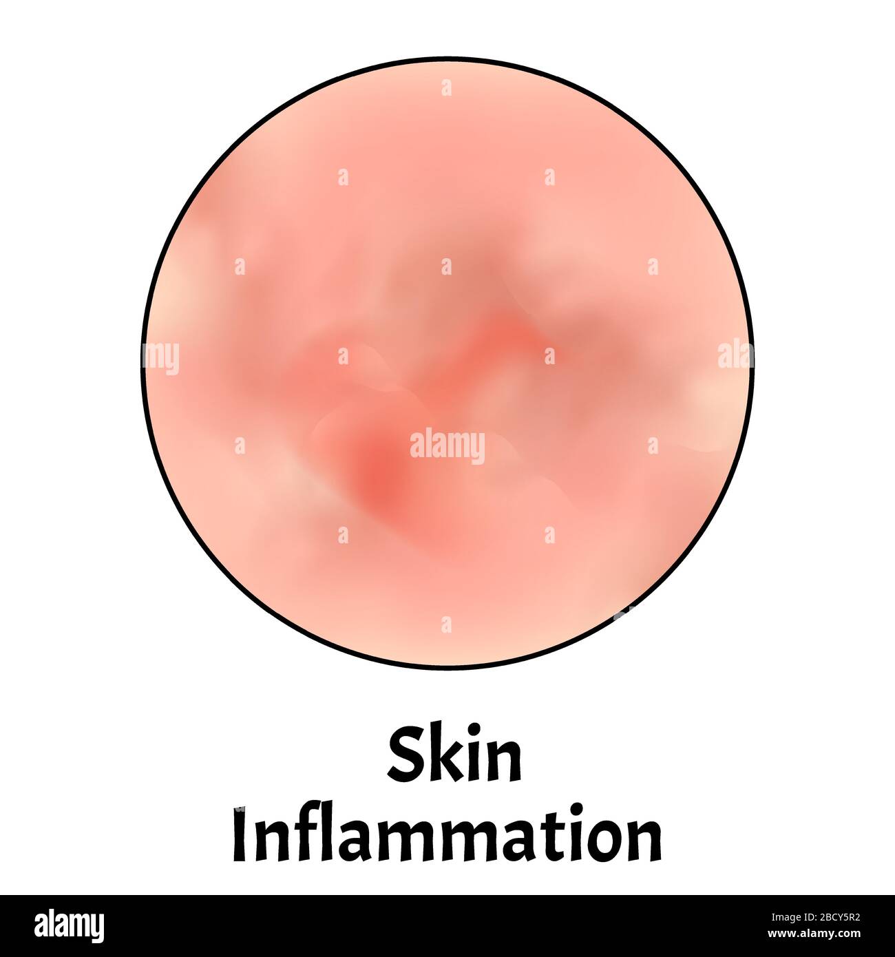 Skin inflammation. Dermatitis skin. Infographics. Vector illustration on isolated background. Stock Vector