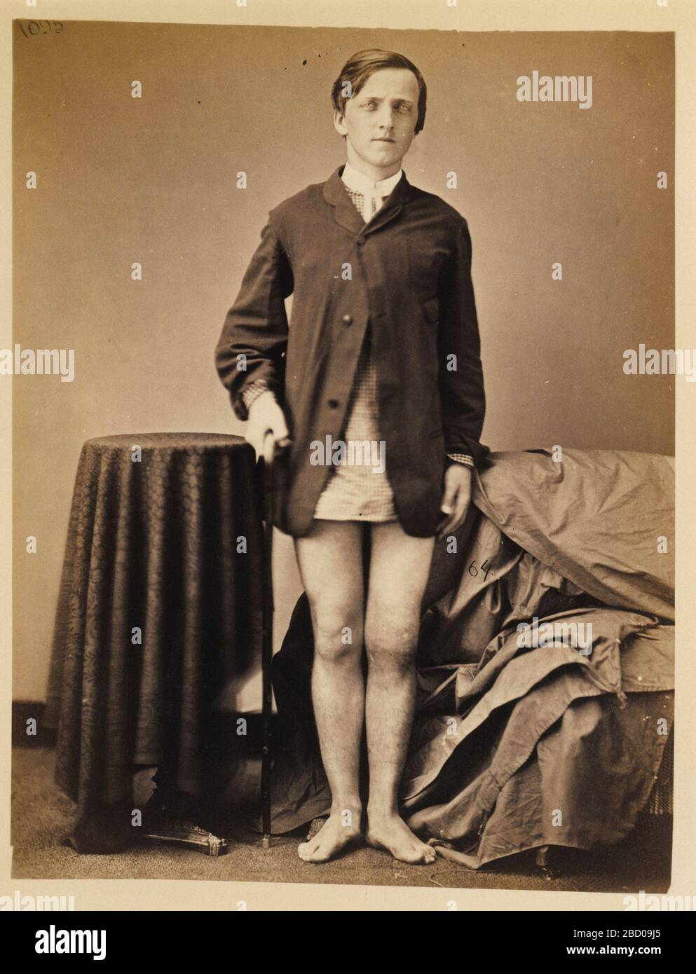 Private G W Warrington Recovery without Amputation after Gunshot Fracture of the Right Patella from the Photographic Catalogue of the Surgical Section. Stock Photo