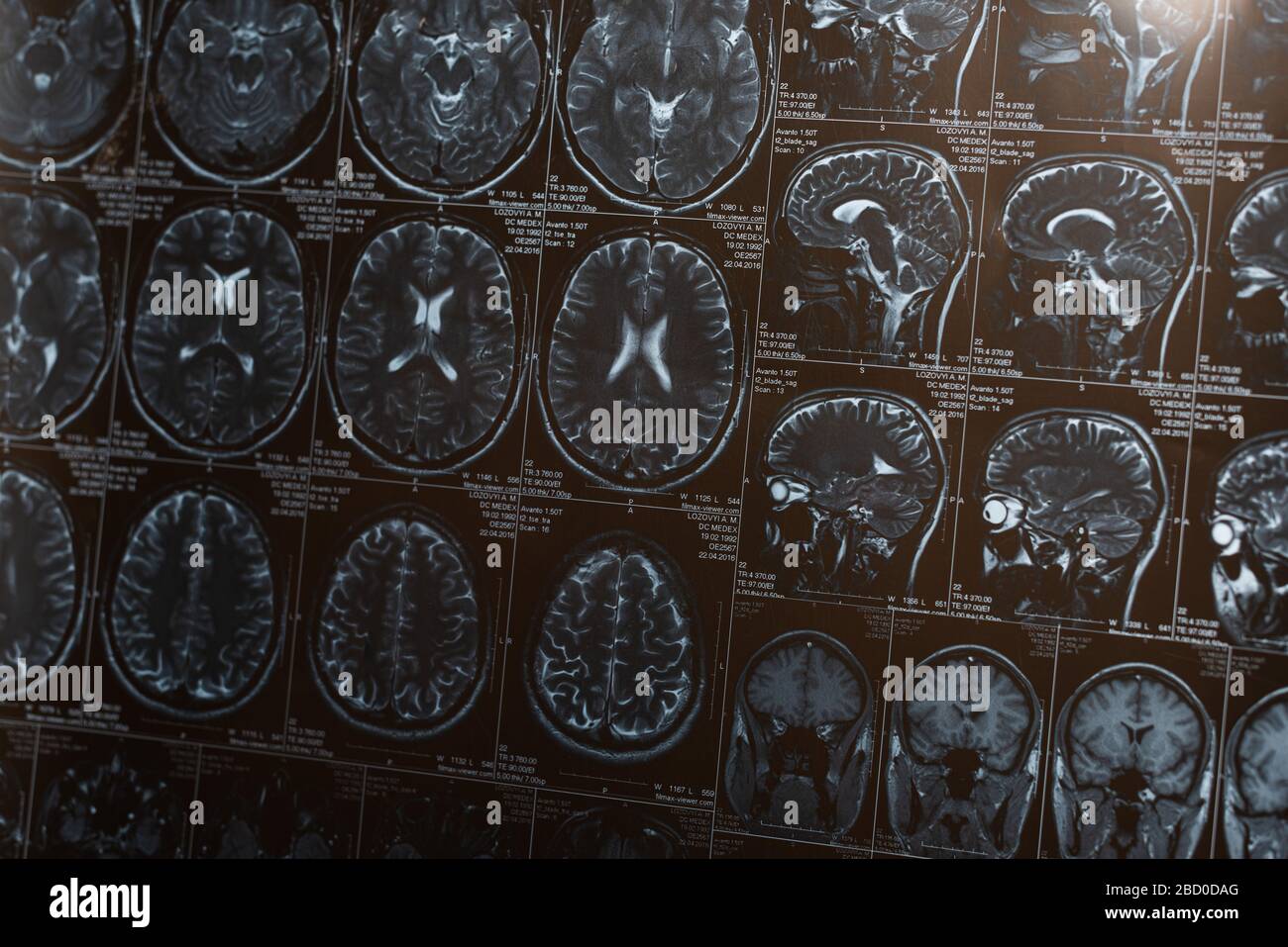 Magnetic resonance imaging of brain, concept of alzheimer disease Stock ...