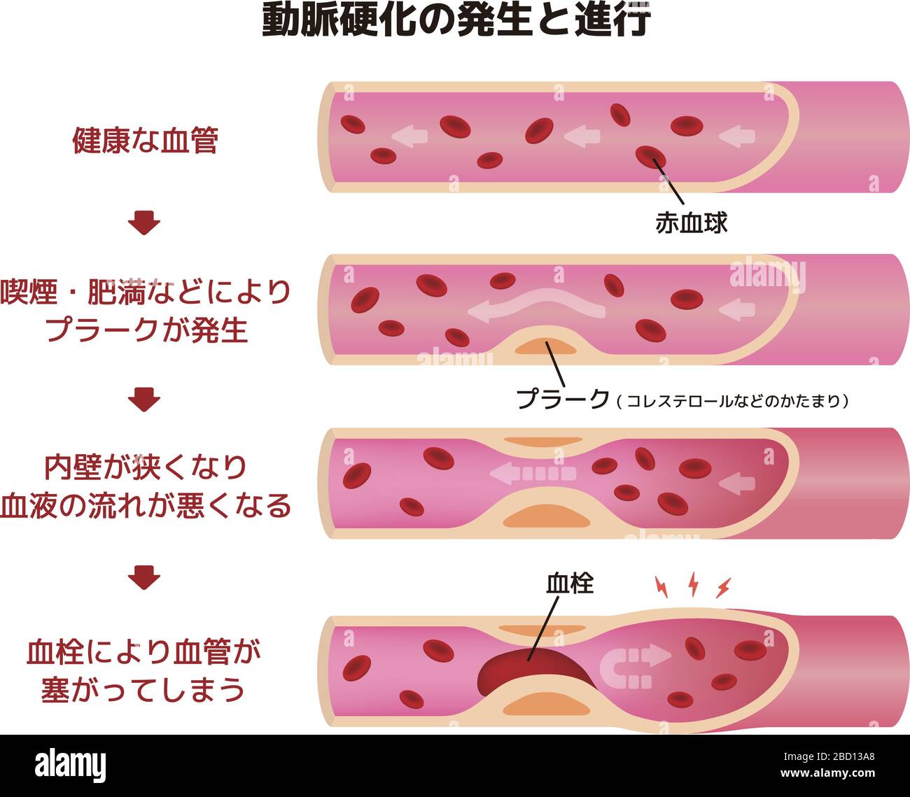 Progression of arteriosclerosis illustration Stock Vector Image & Art ...