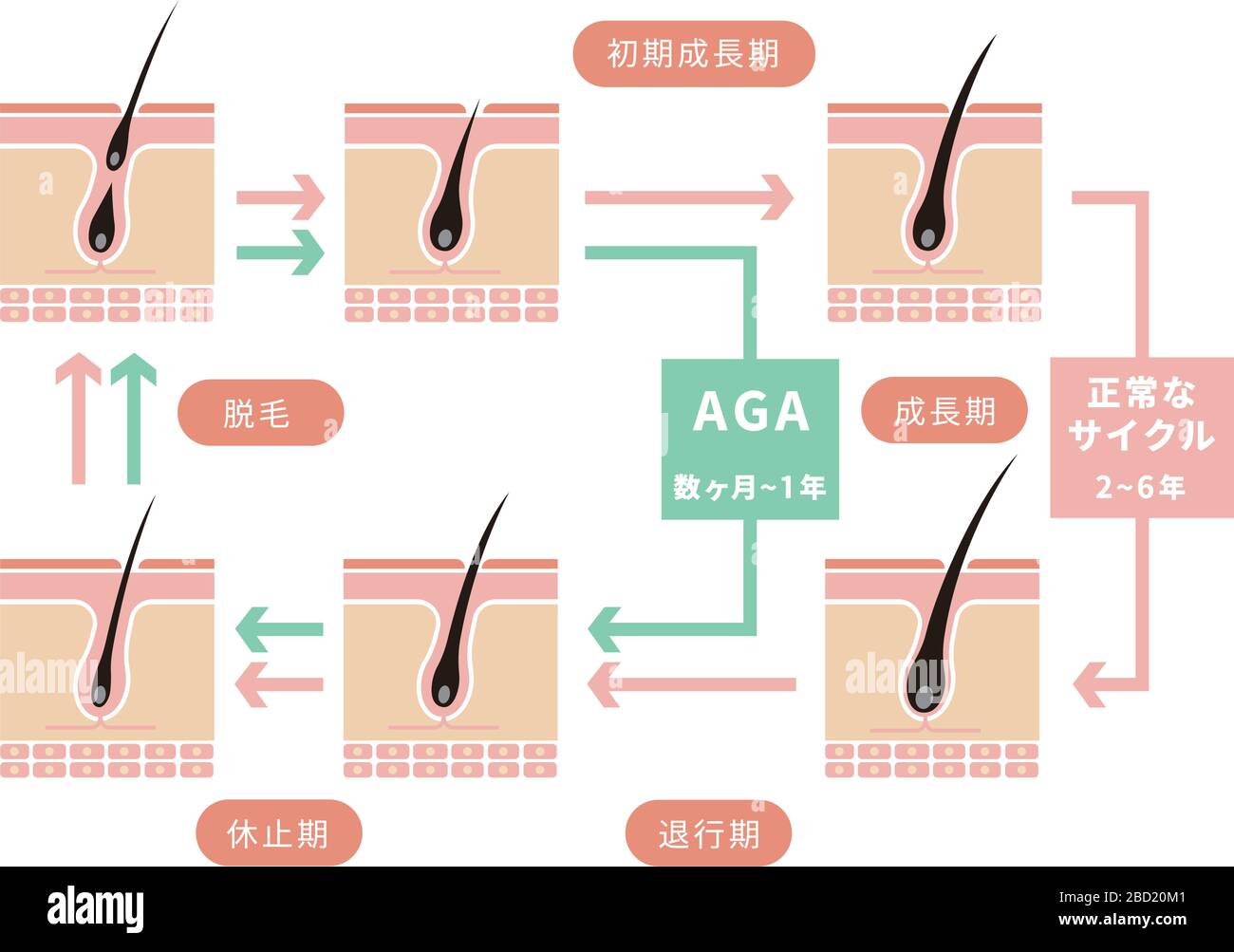 Comparative Illustration Of Normal Hair Cycle And Aga Androgenetic Alopecia Stock Vector Image Art Alamy Comparative Illustration Of Normal Hair Cycle And Aga Androgenetic Alopecia Stock Vector Image Art Alamy