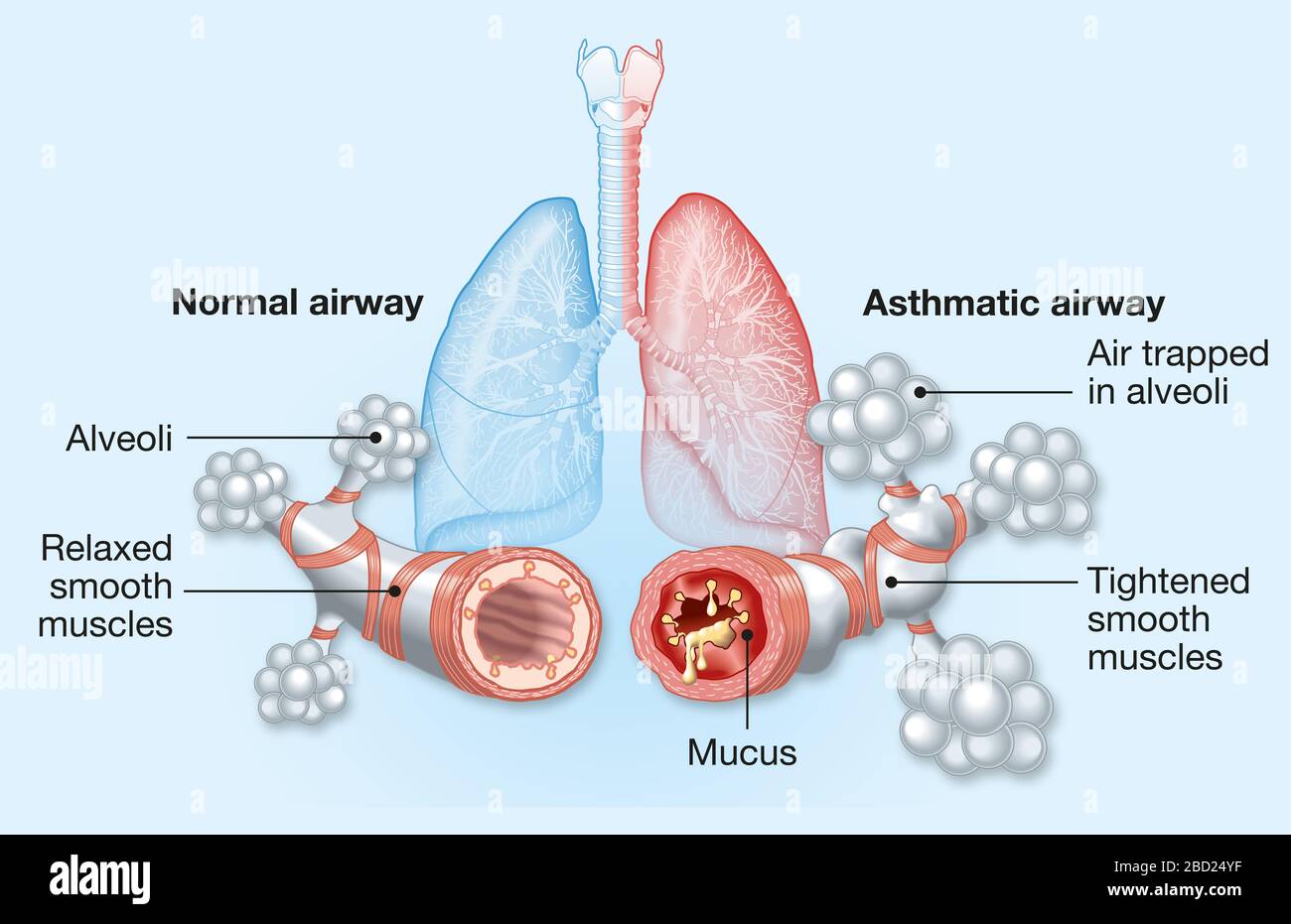 Diagram showing Asthma, normal and asthmatic airways, medically