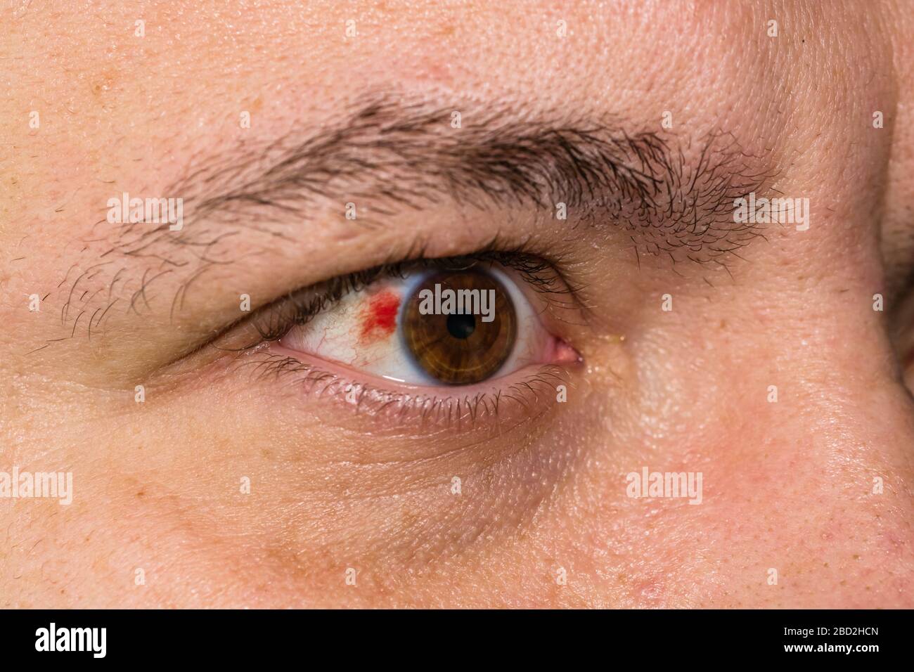 burst blood vessel in eye