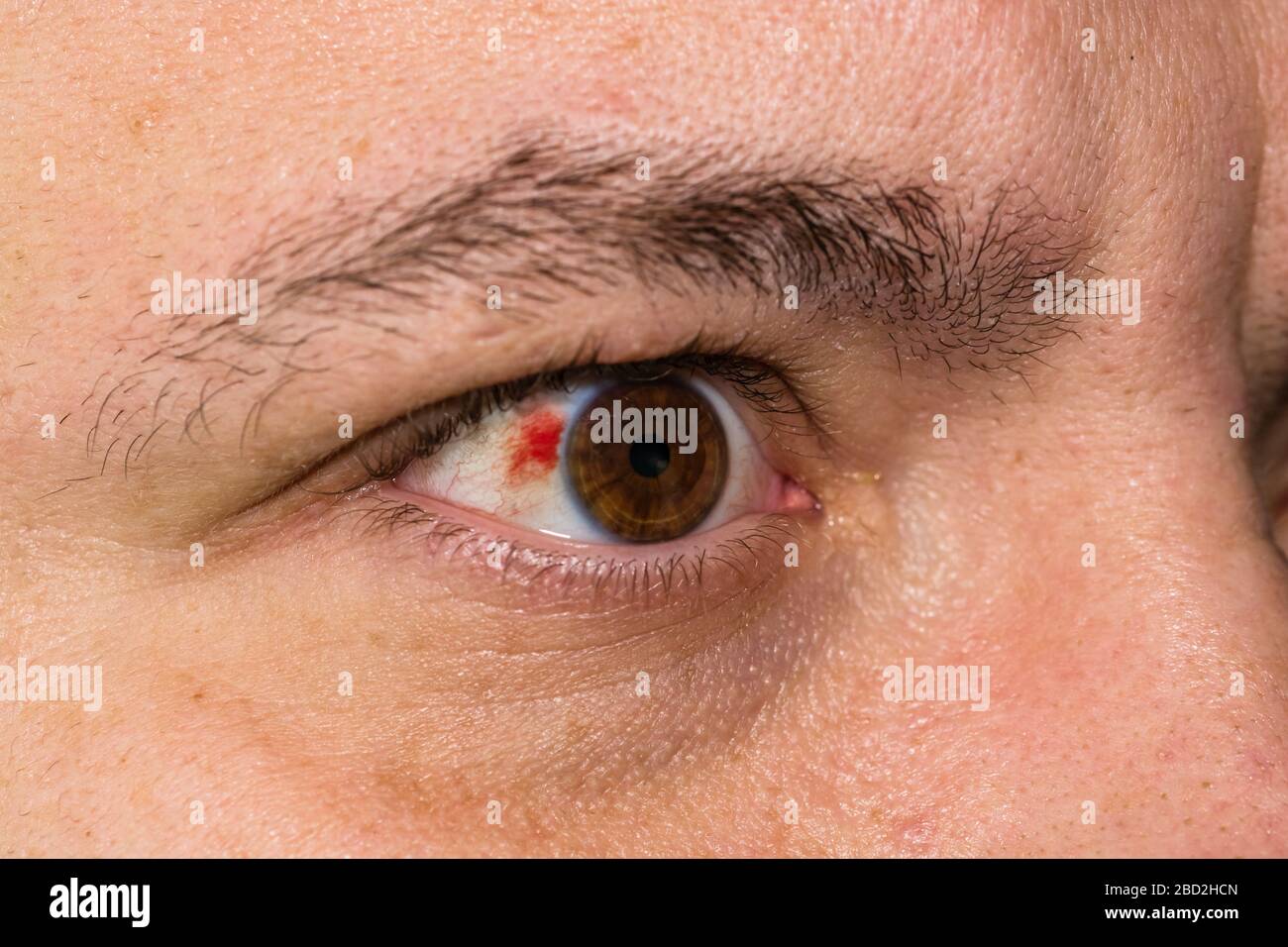 Burst Blood Vessel In Eye Lasopafusion