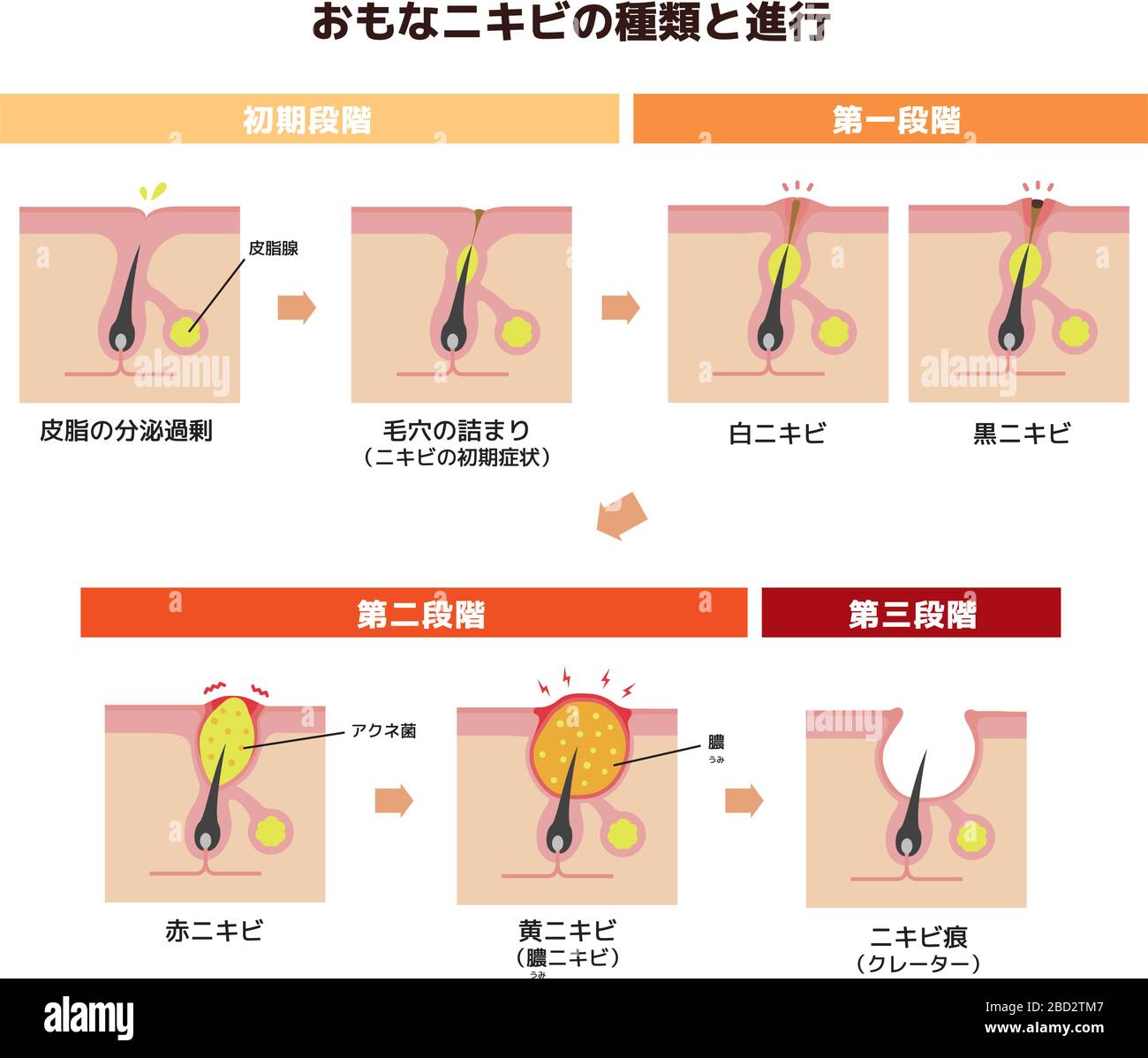 Acne types and progression illustration Stock Vector