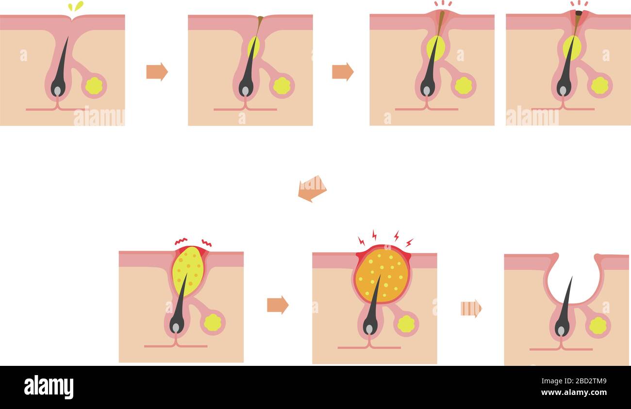 Acne types and progression illustration Stock Vector