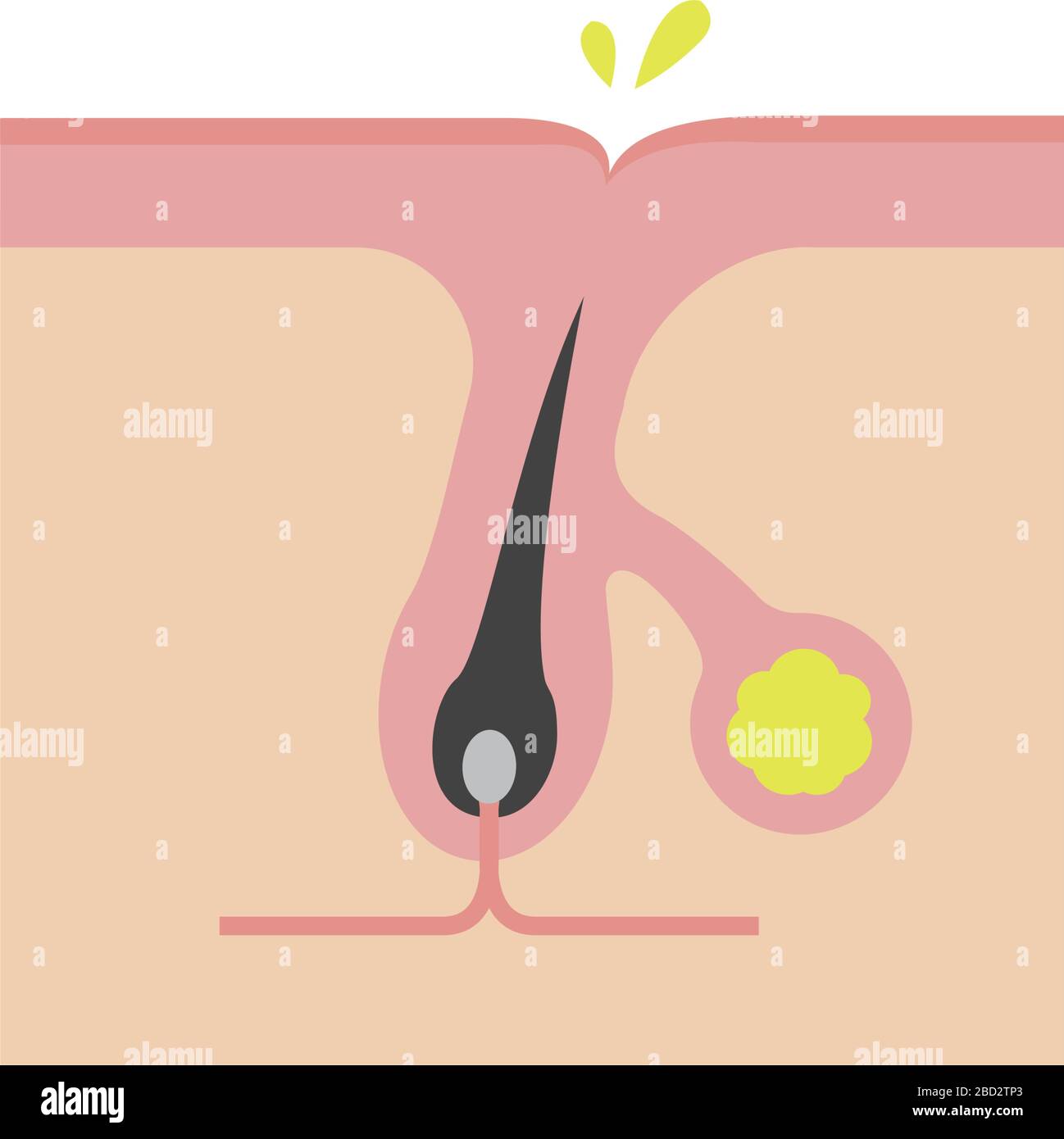 Excessive Secretion From Sebaceous Glands