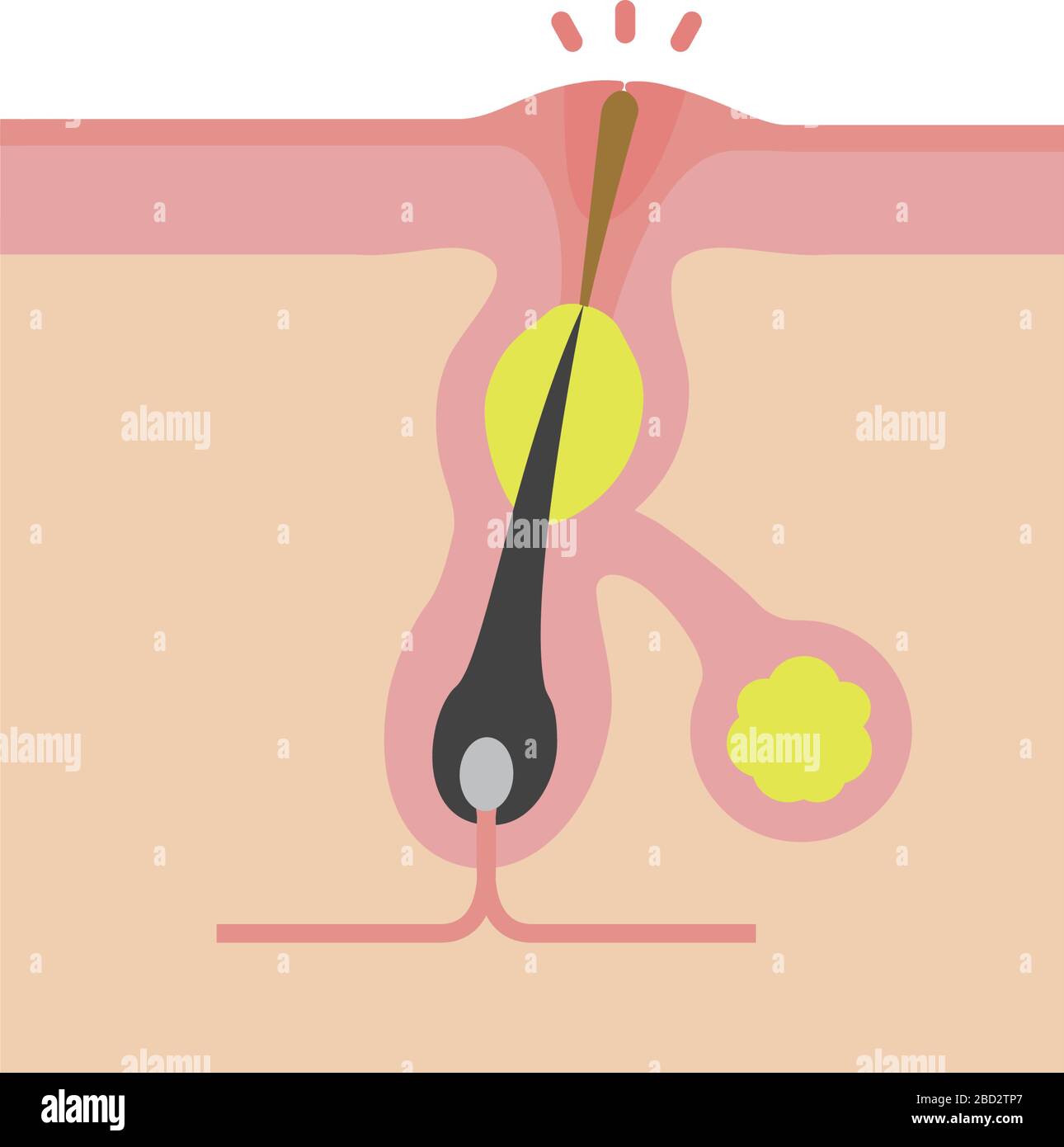 Cross section of pores ( acne progression) / Whitehead Stock Vector