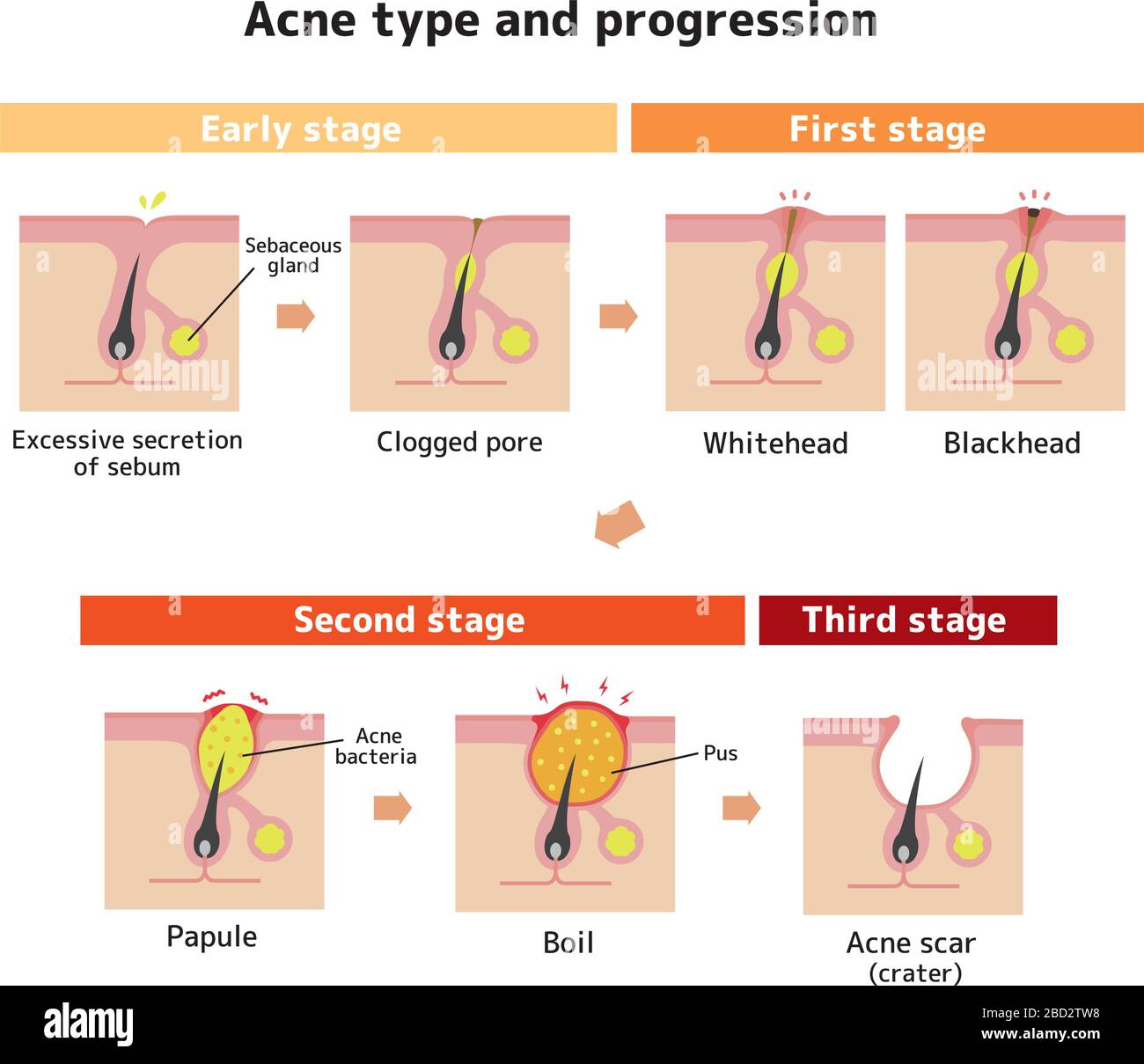 Acne types and progression illustration Stock Vector