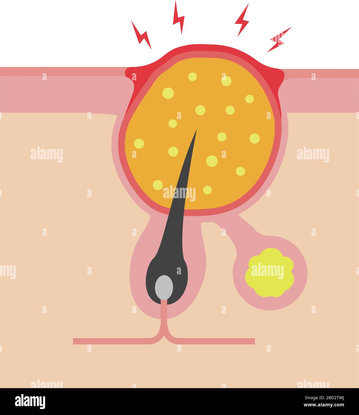 Cross section of pores ( acne progression) / Boil Stock Vector