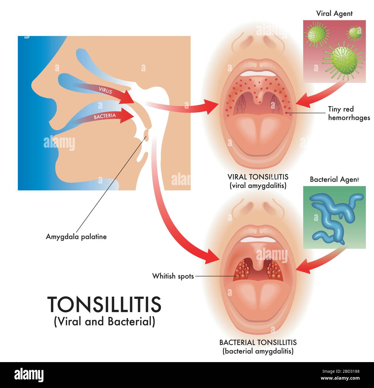 Medical illustration of the symptoms of viral and bacterial tonsillitis, also called viral amygdalitis and bacterial amygdalitis, with the pathogens t Stock Vector