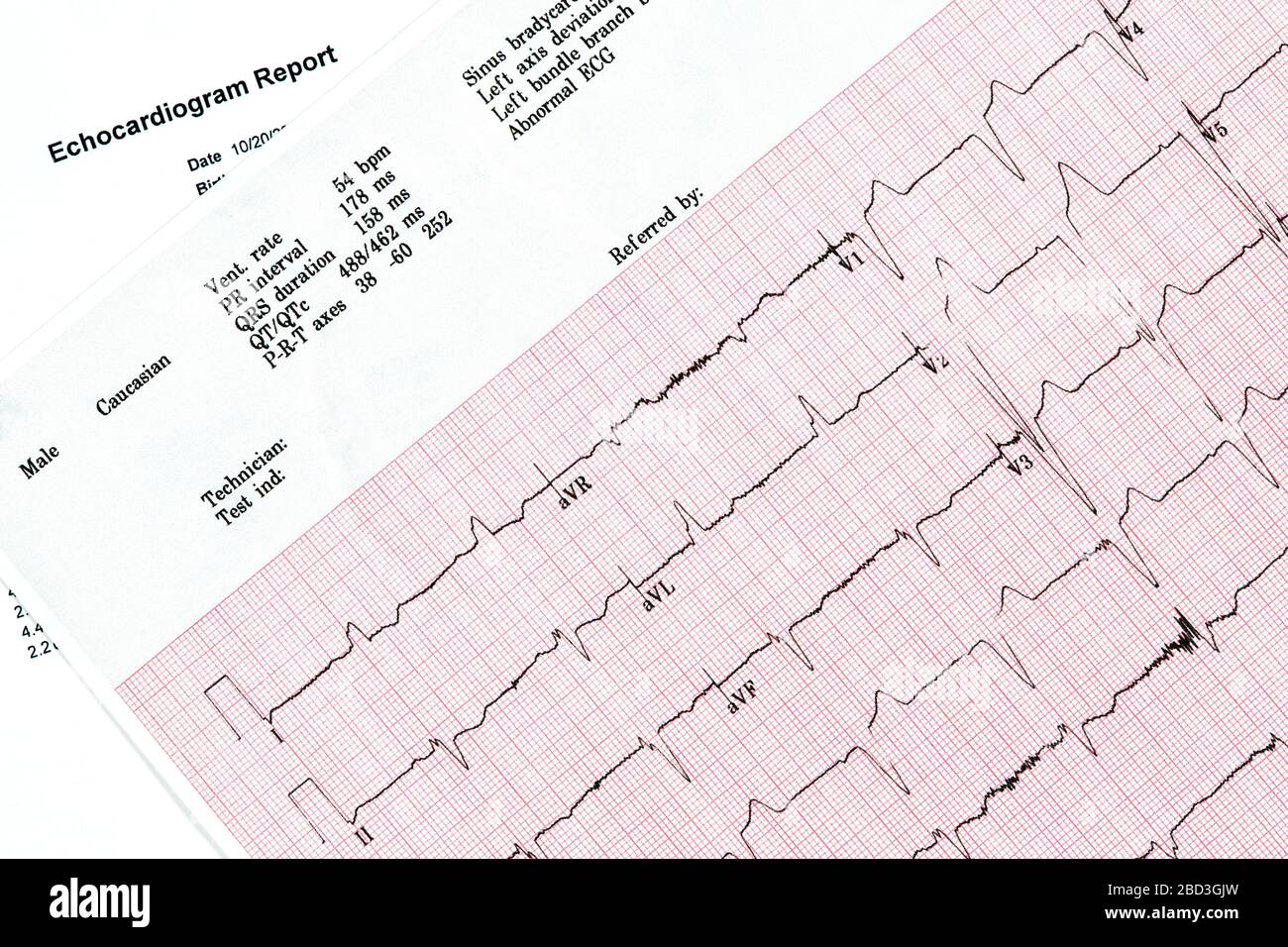 Close Up of Ecocardiography report (ECG) showing irregular heartbeat Stock Photo