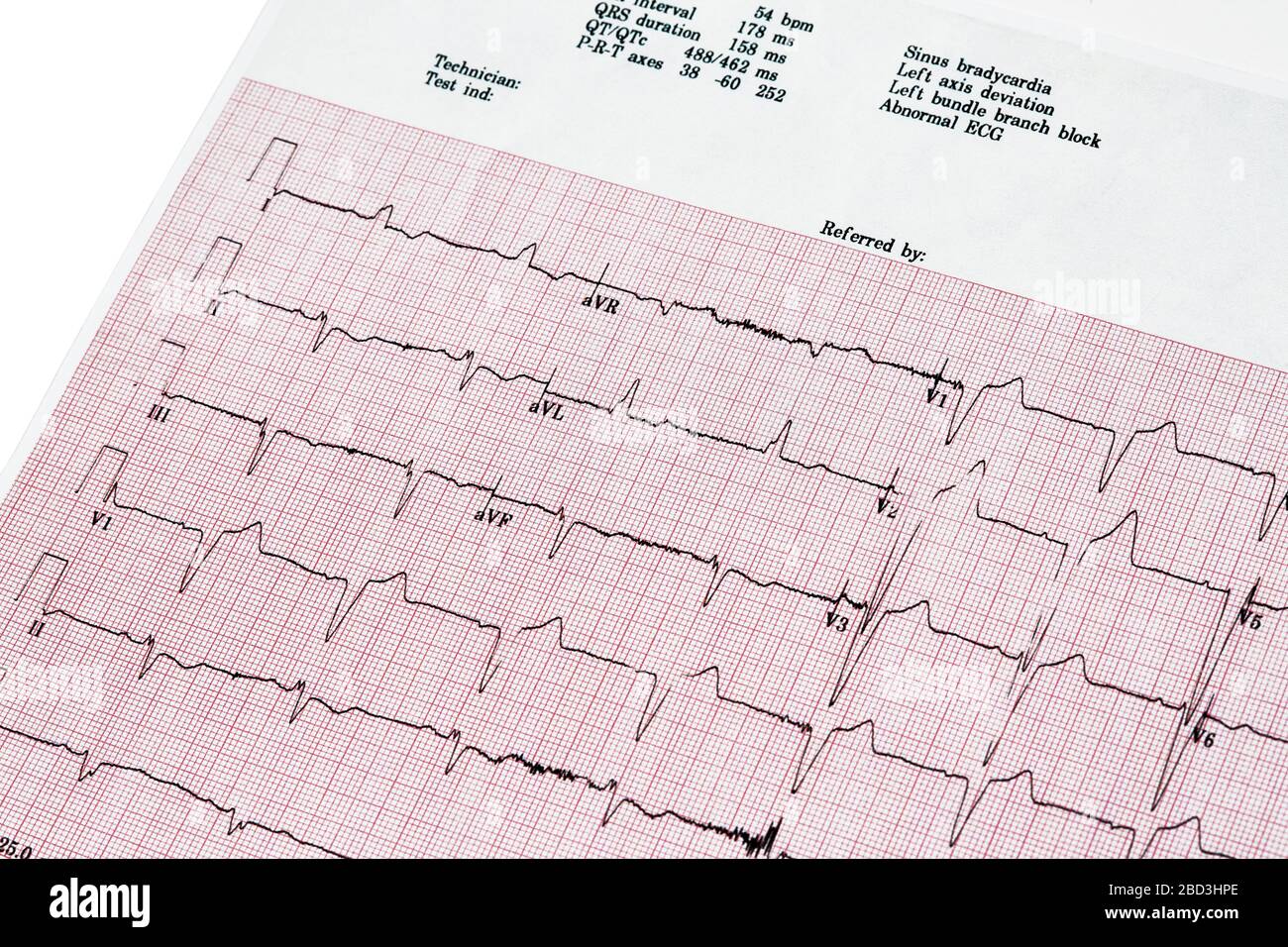 Close Up of Ecocardiography report (ECG) showing irregular heartbeat Stock Photo