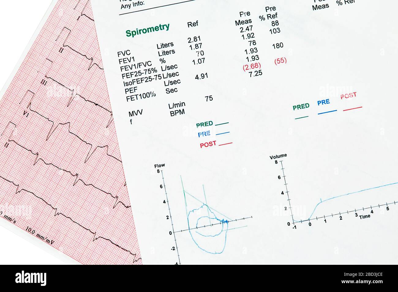 Close Up of pulmonary report showing spirometry graph with an ECG graph behind it Stock Photo