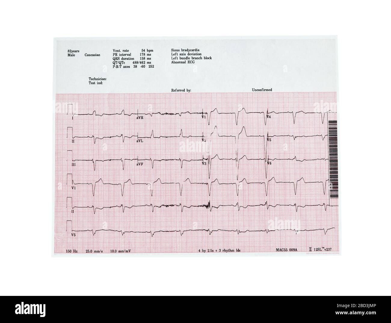 Ecocardiography report (ECG) showing irregular heartbeat isolated on white Stock Photo