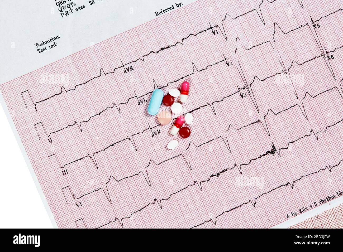 Close Up Echocardiograph test report (ECG) showing abnormal heart rhythm with medication Stock Photo