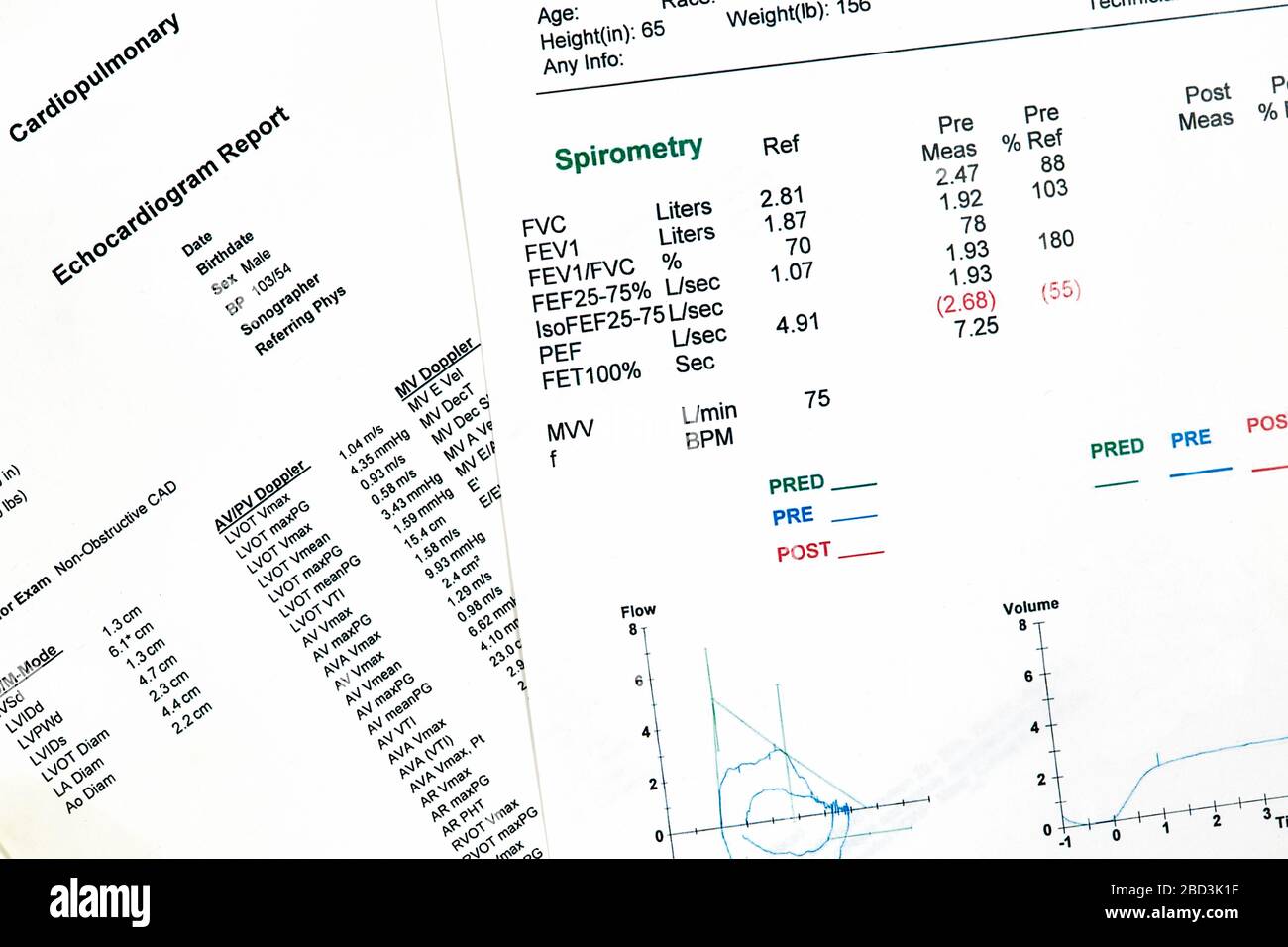 Close Up of Ecocardiography report (ECG) and a pulmonary Functions test with spirometry Stock Photo