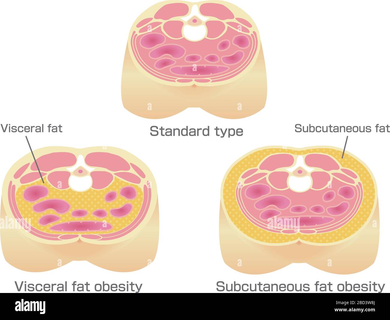 Visceral fat hi-res stock photography and images - Alamy