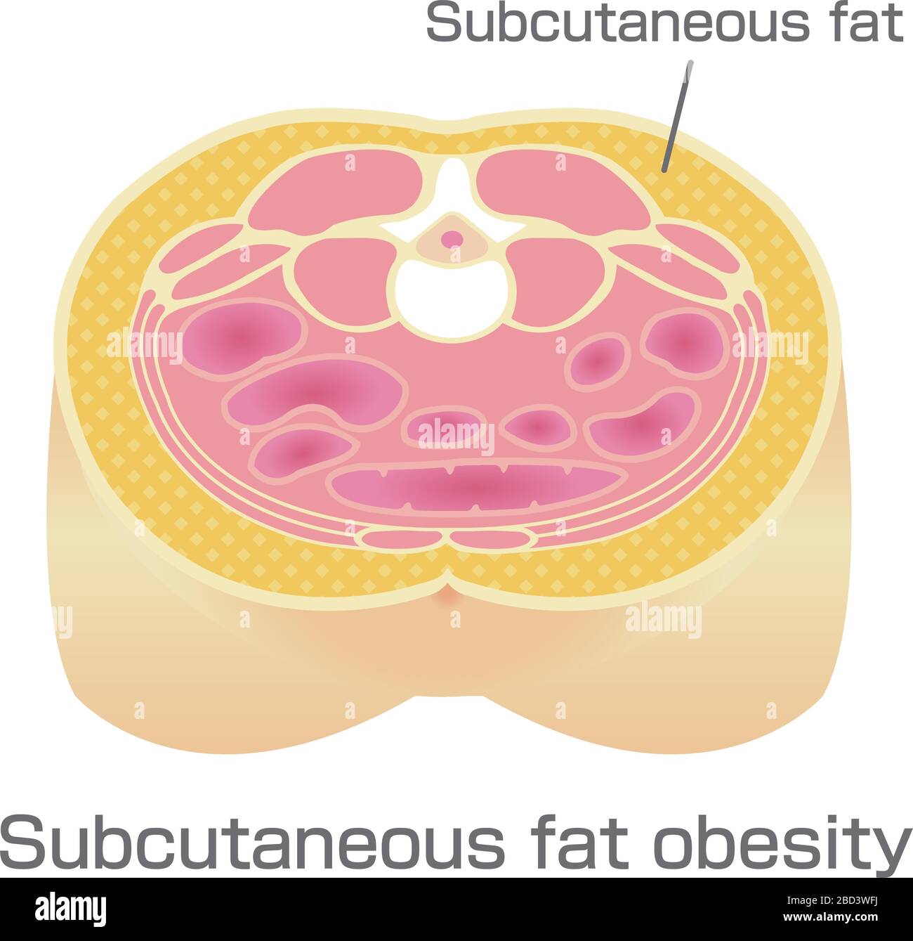 Subcutaneous Fat High Resolution Stock Photography and Images Alamy