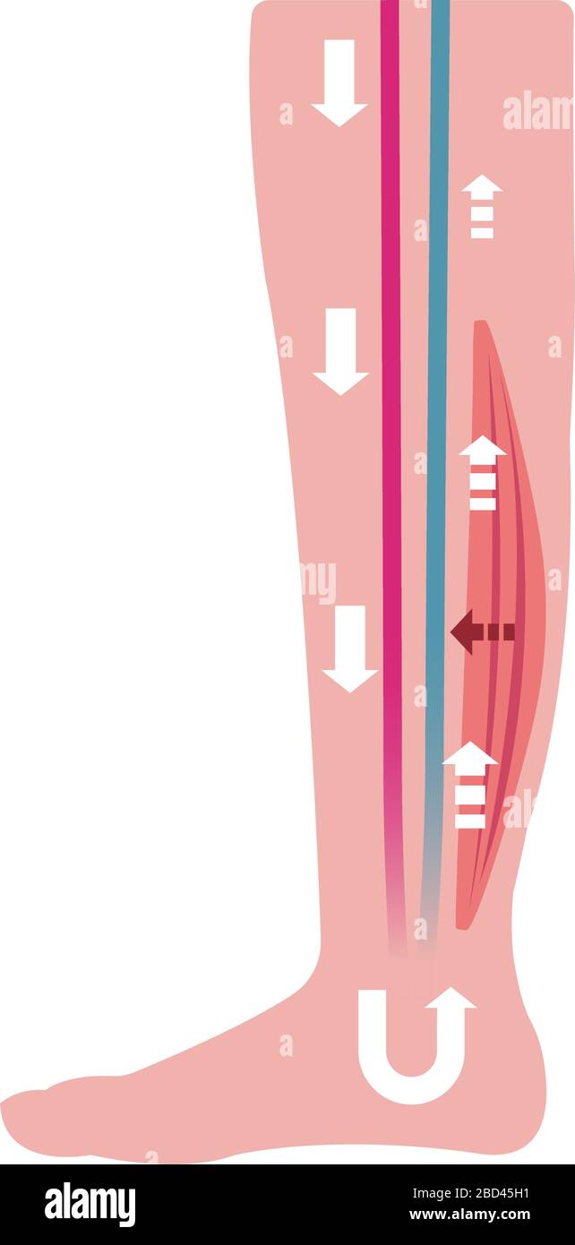 Cause of swelling(edema) of the legs. Decreased blood flow due to muscle weakness. flat illustration. Stock Vector