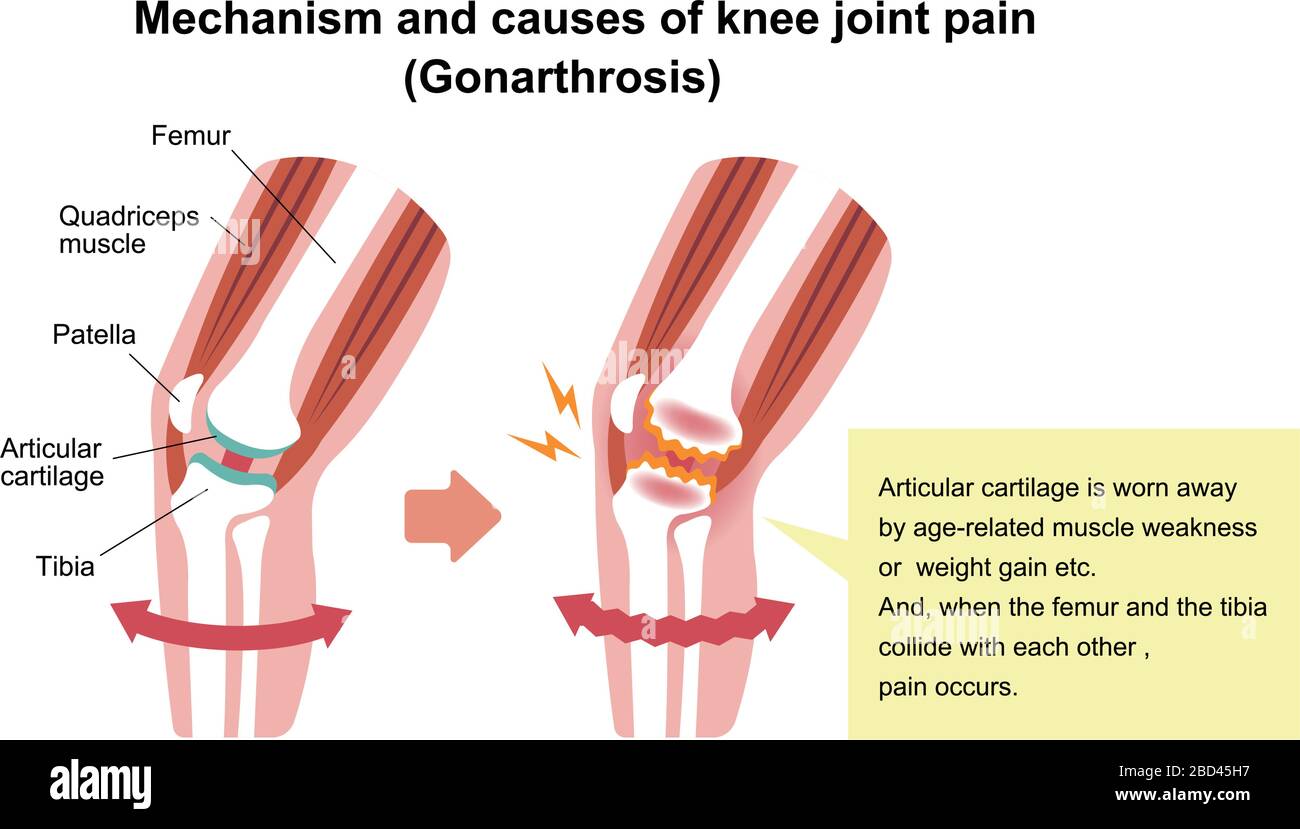Osteoarthritis Of The Knee Joint Hi res Stock Photography And Images osteoarthritis-of-the-knee-joint-hi-res-stock-photography-and-images
