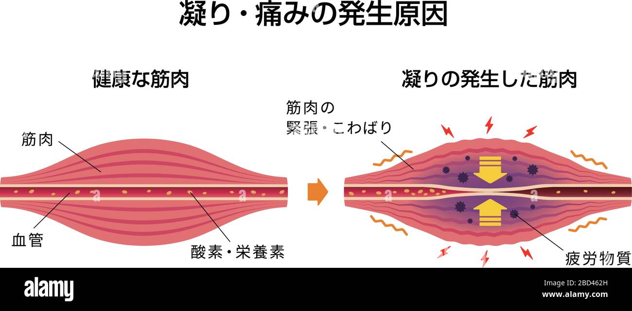 Cause of muscle's stiffness and pain illustration Stock Vector Image