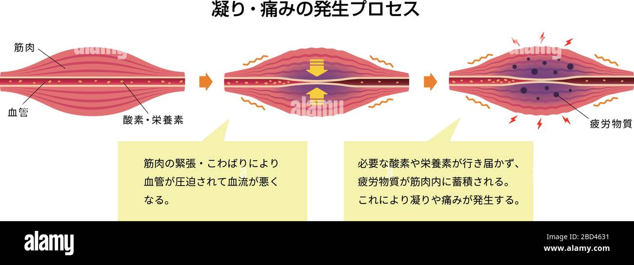 Cause of muscle's stiffness and pain illustration (3 steps Stock Vector
