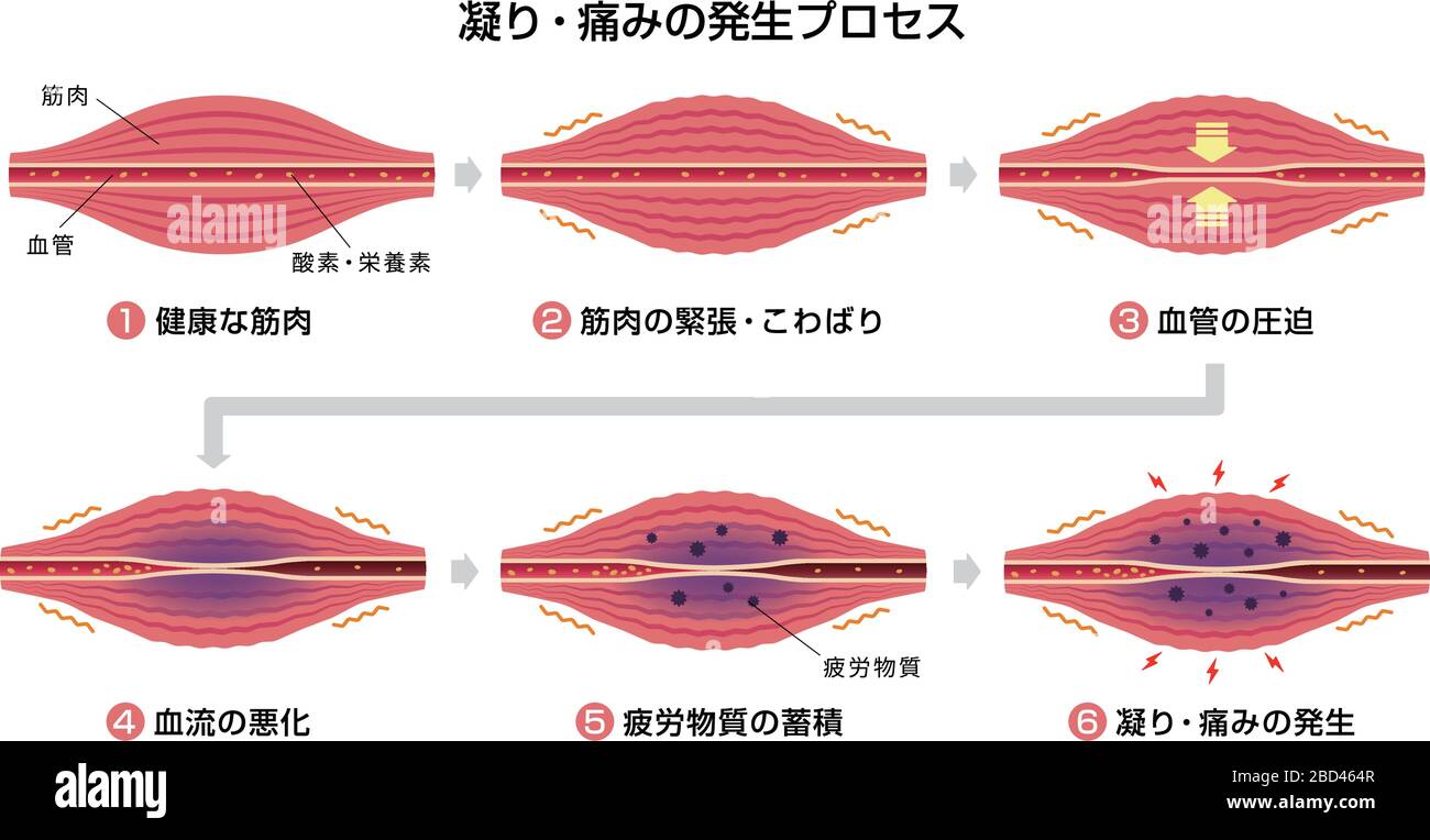 Process of muscle's stiffness and pain illustration ( 6 steps Stock