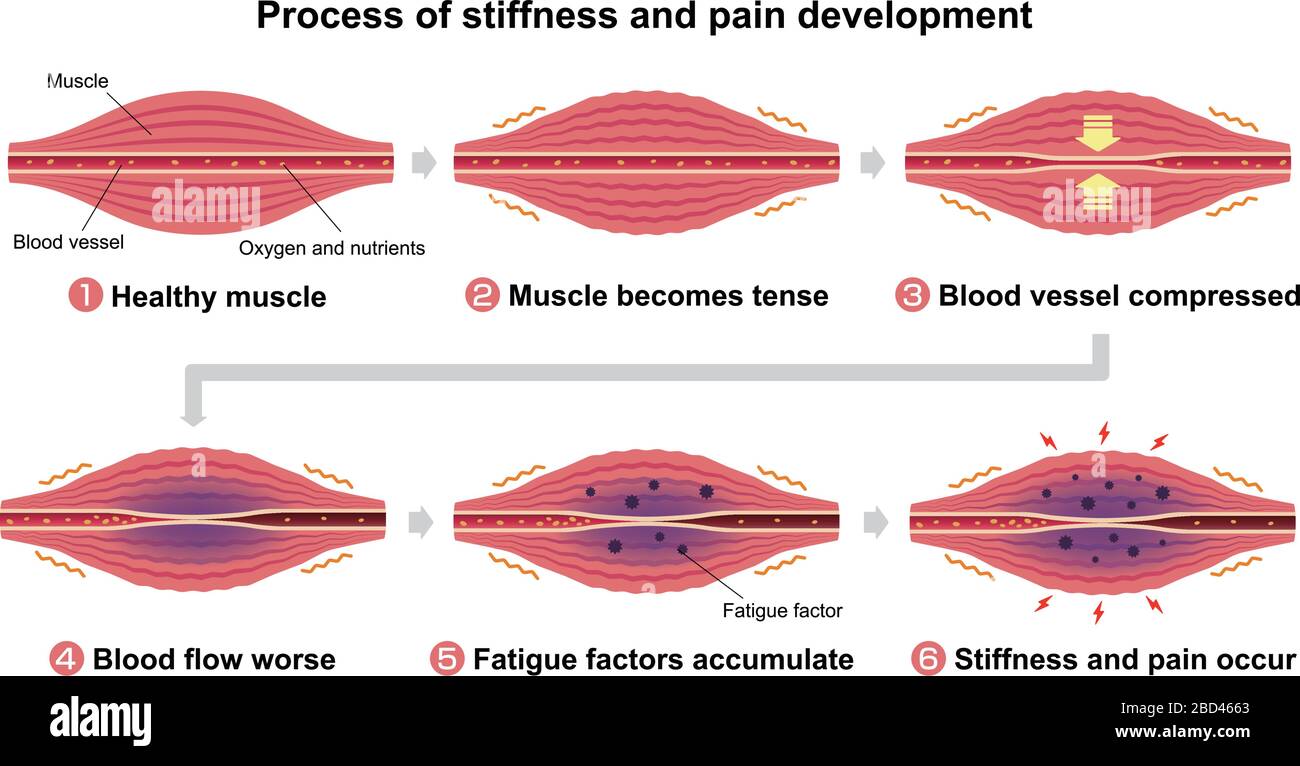 Process of muscle's stiffness and pain illustration ( 6 steps Stock Vector  Image & Art - Alamy