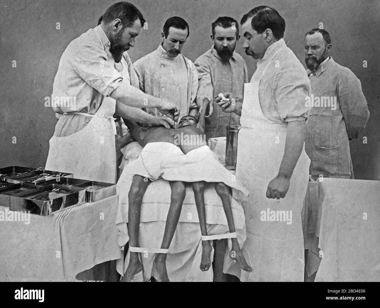 Dr. Eugene-Louis Doyen performing surgery to separate conjoined twins Radica and Doodica in 1902 Stock Photo