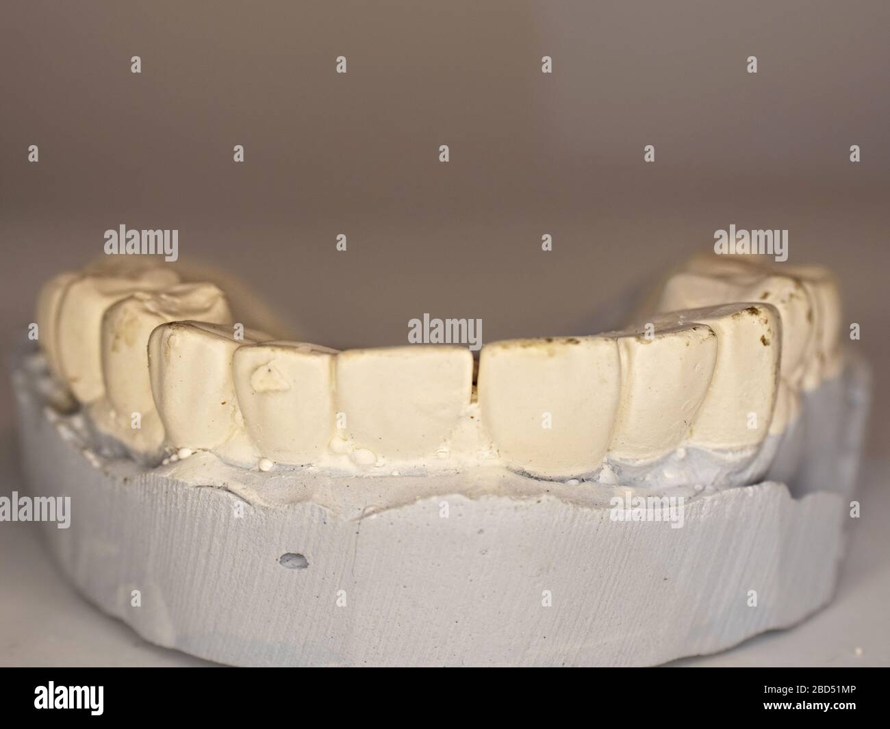 Plaster cast of teeth of removable partial denture Stock Photo Alamy