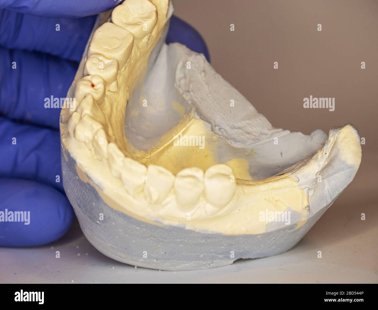 Dental gypsum mold with crooked teeth. Dentist holding Dental Gypsum