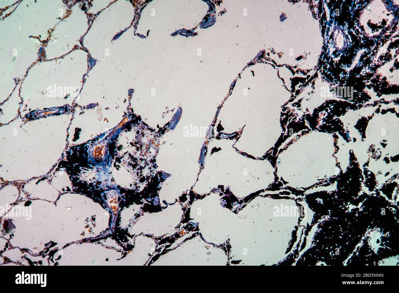 Charcoal dust lung tissue under the microscope 100x Stock Photo Alamy