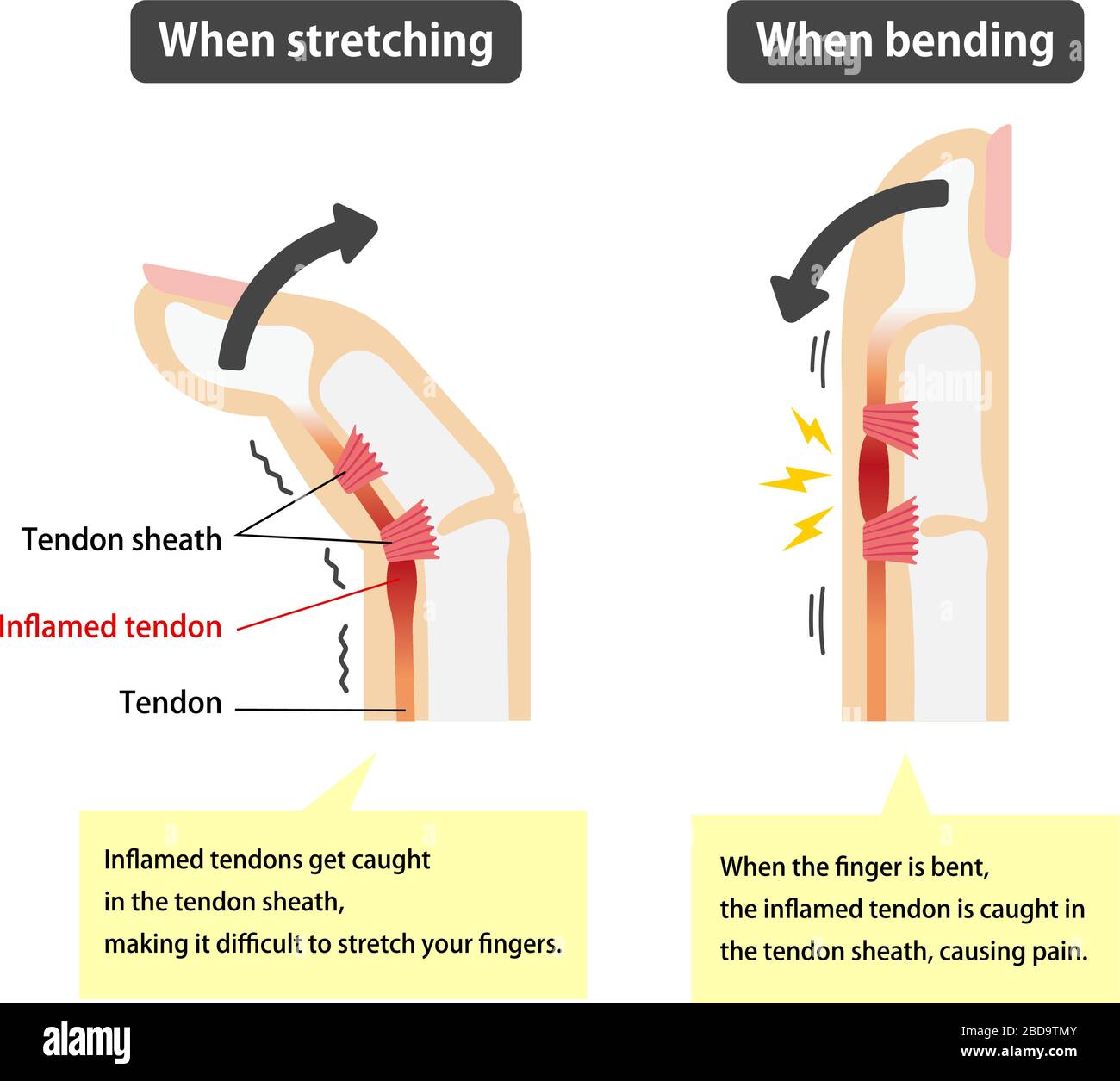 Trigger finger causes and symptoms illustration / English (with