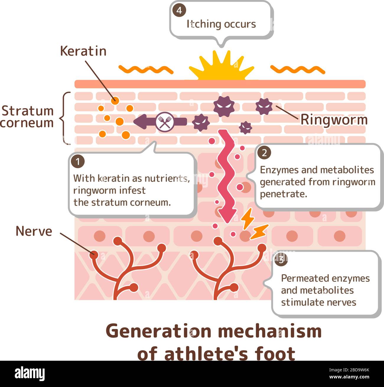 Generation mechanisim of athlete's foot ( ringworm) vector illustration / with English explanation texts. Stock Vector