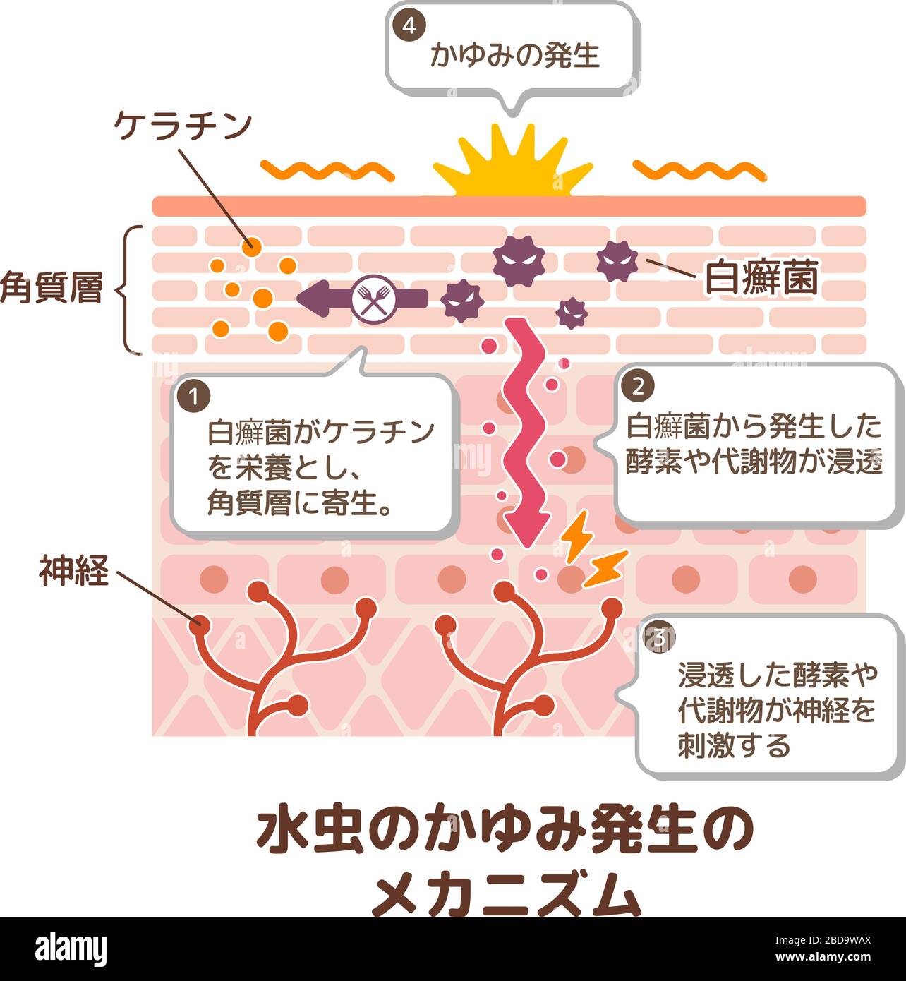 Generation mechanisim of athlete's foot ( ringworm) vector illustration / with Japanese explanation texts. Stock Vector