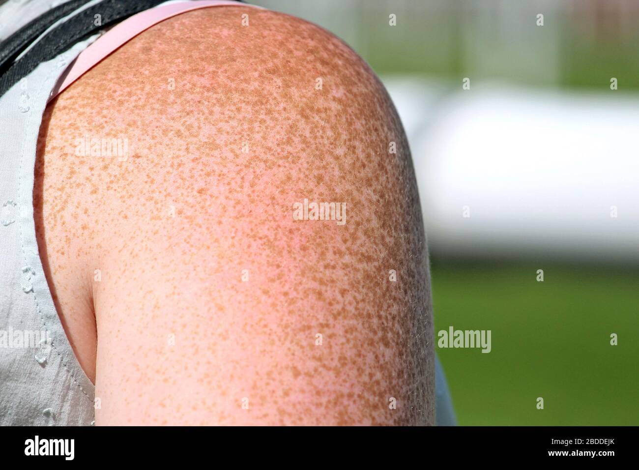 Freckles arm hires stock photography and images Alamy