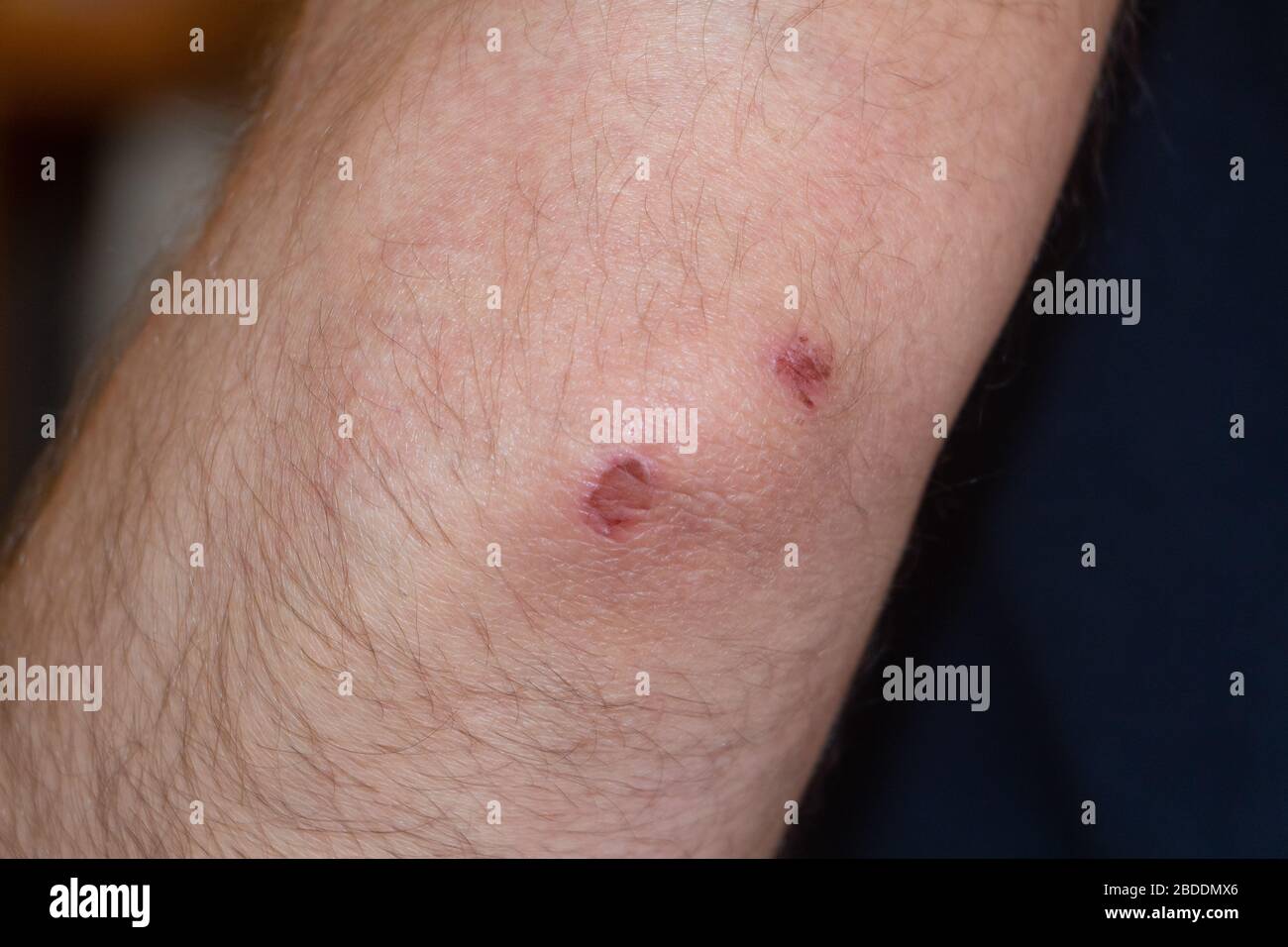 Close-up of the elbow of a man grazed Stock Photo