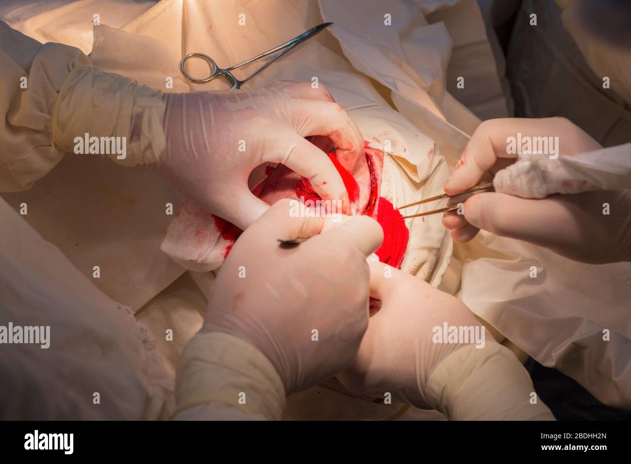 top view, stages of neurosurgical surgery for installing a titanium plate in the patients skull. Pediatric neurosurgery. Craniotomy. Incision of the s Stock Photo