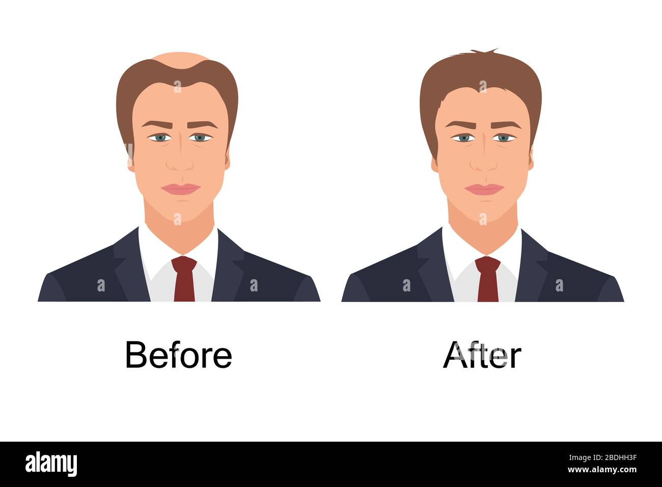 Man with alopecia before and after hair treatment and transplantation. Male baldness problem solution. Health and beauty concept for diagnostic Stock Vector