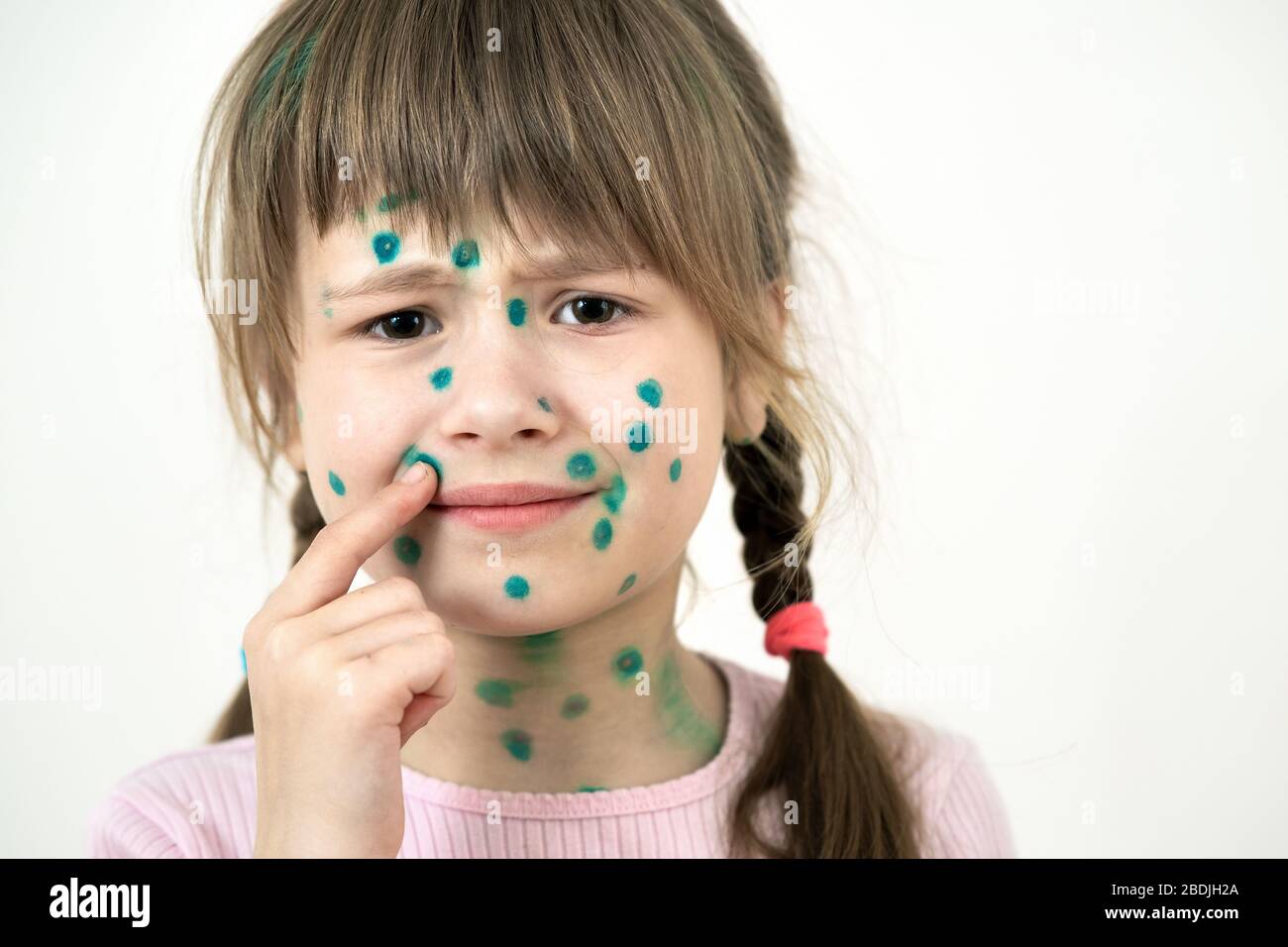 Child girl covered with green rashes on face ill with chickenpox, measles or rubella virus. Stock Photo