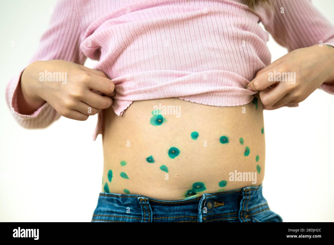 Child covered with green rashes on stomach ill with chickenpox, measles or rubella virus. Stock Photo