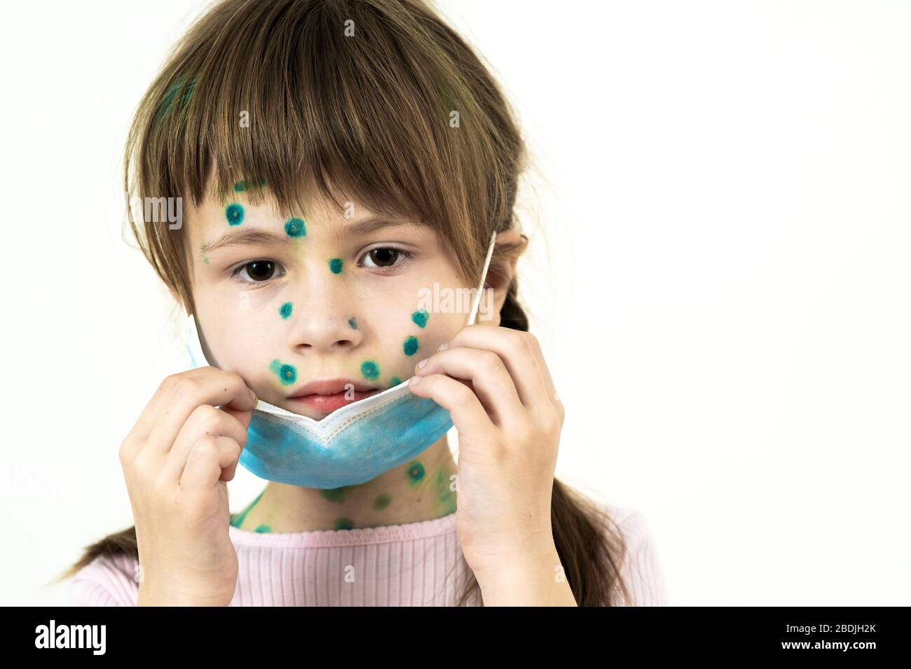 Child girl wearing blue protective medical mask ill with chickenpox, measles or rubella virus with rashes on body. Children protection during epidemic Stock Photo