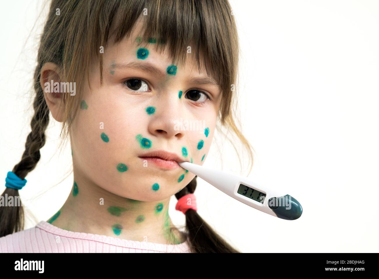 Child girl covered with green rashes on face ill with chickenpox, measles or rubella virus holding medical thermometer in her mouth having high temper Stock Photo