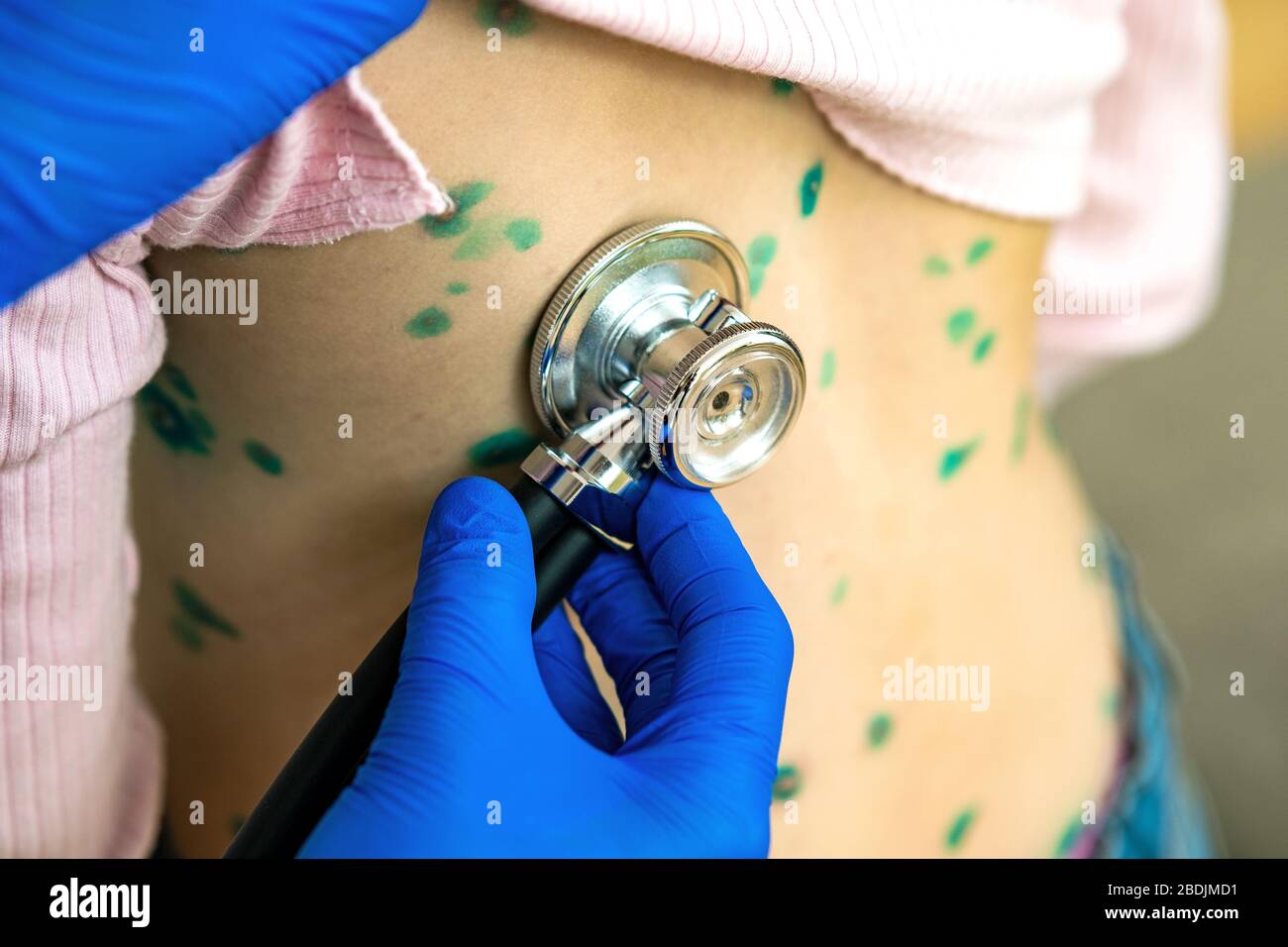 Doctor examining a child with stethoscope covered with green rashes on back ill with chickenpox, measles or rubella virus. Stock Photo